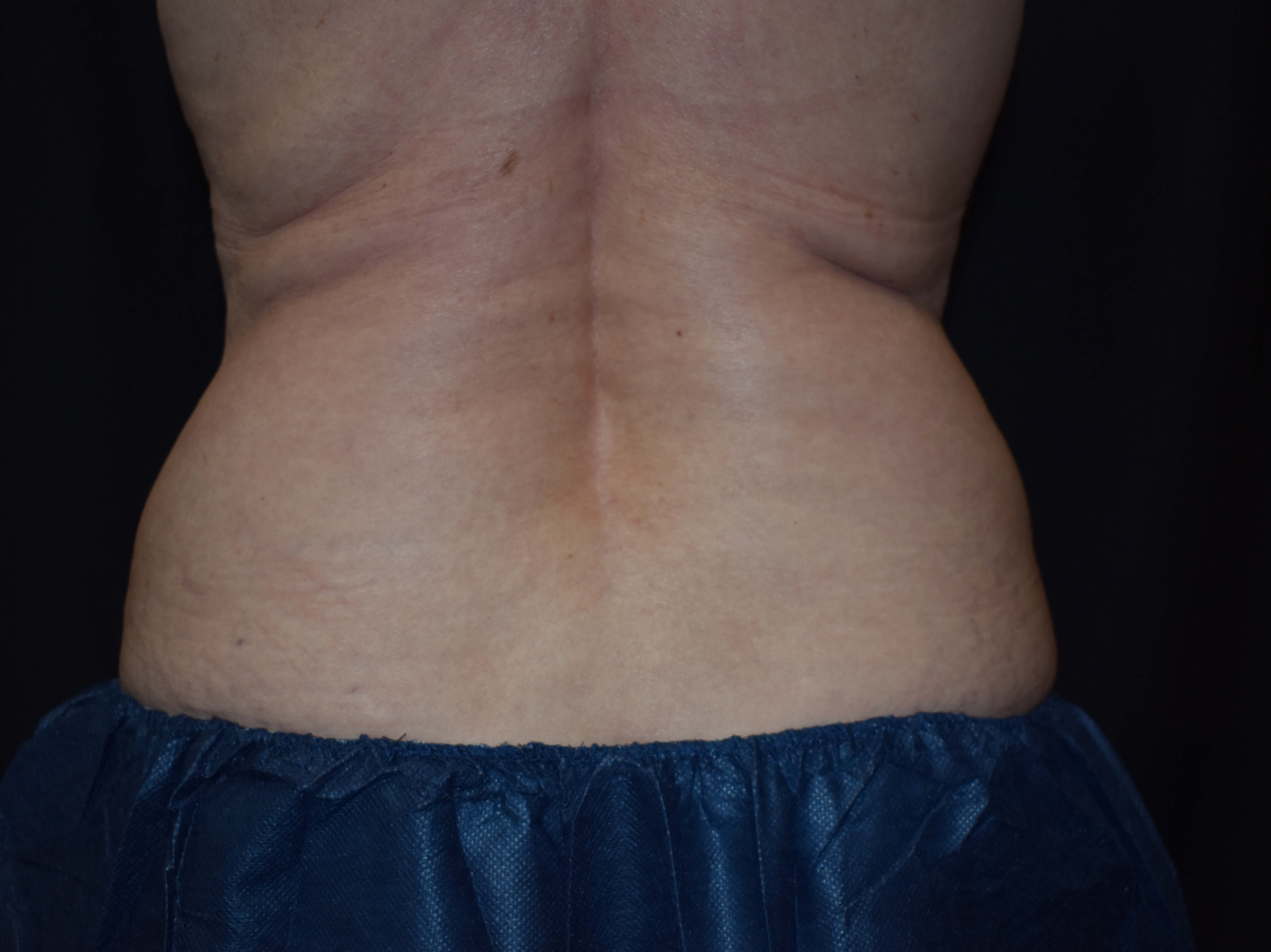 Coolsculpting Bra fat & Flanks Before CoolSculpting