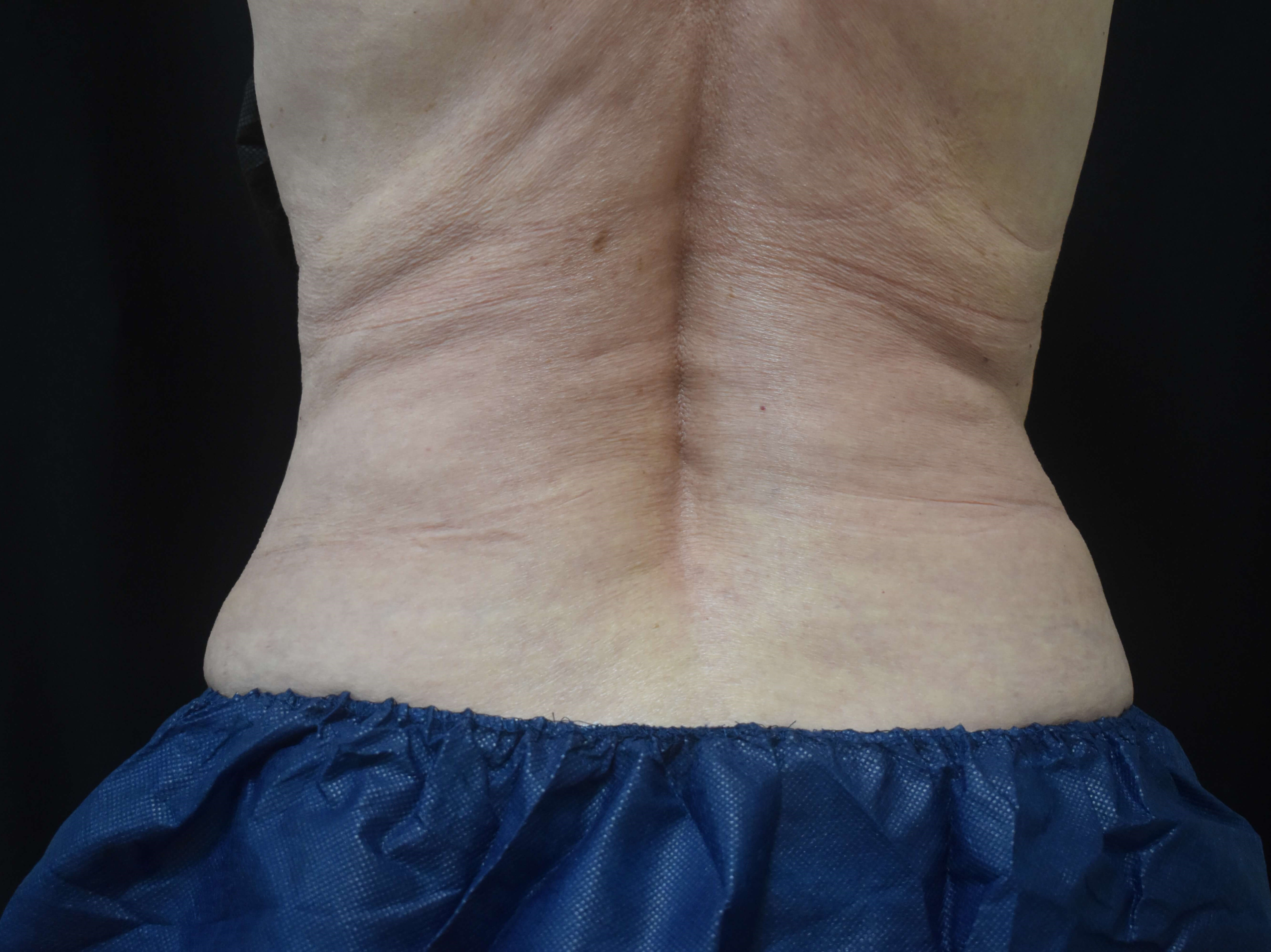 Coolsculpting Bra fat & Flanks 3 months After CoolSculpting
