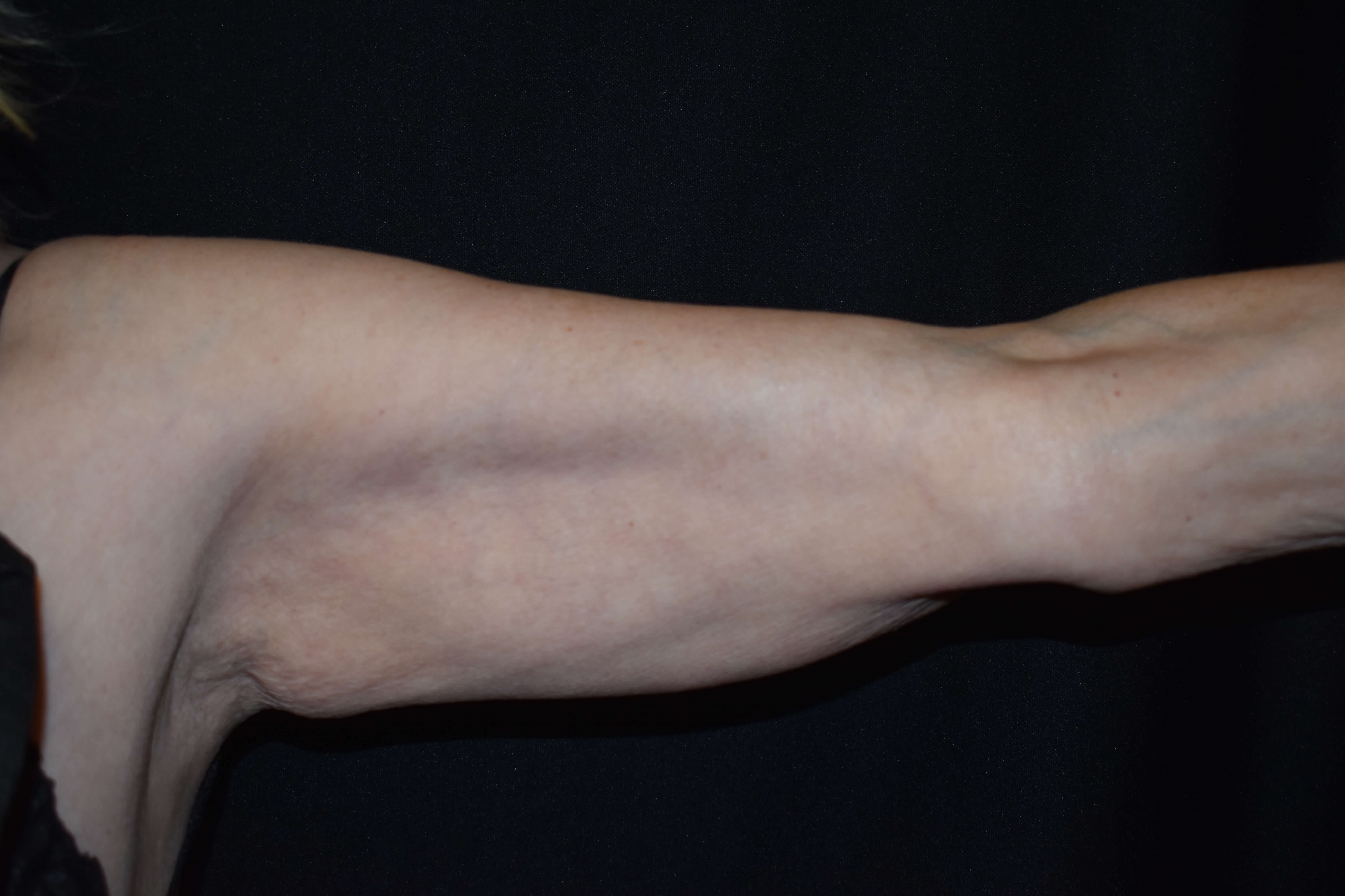 CoolSculpting Arms Before CoolSculpting