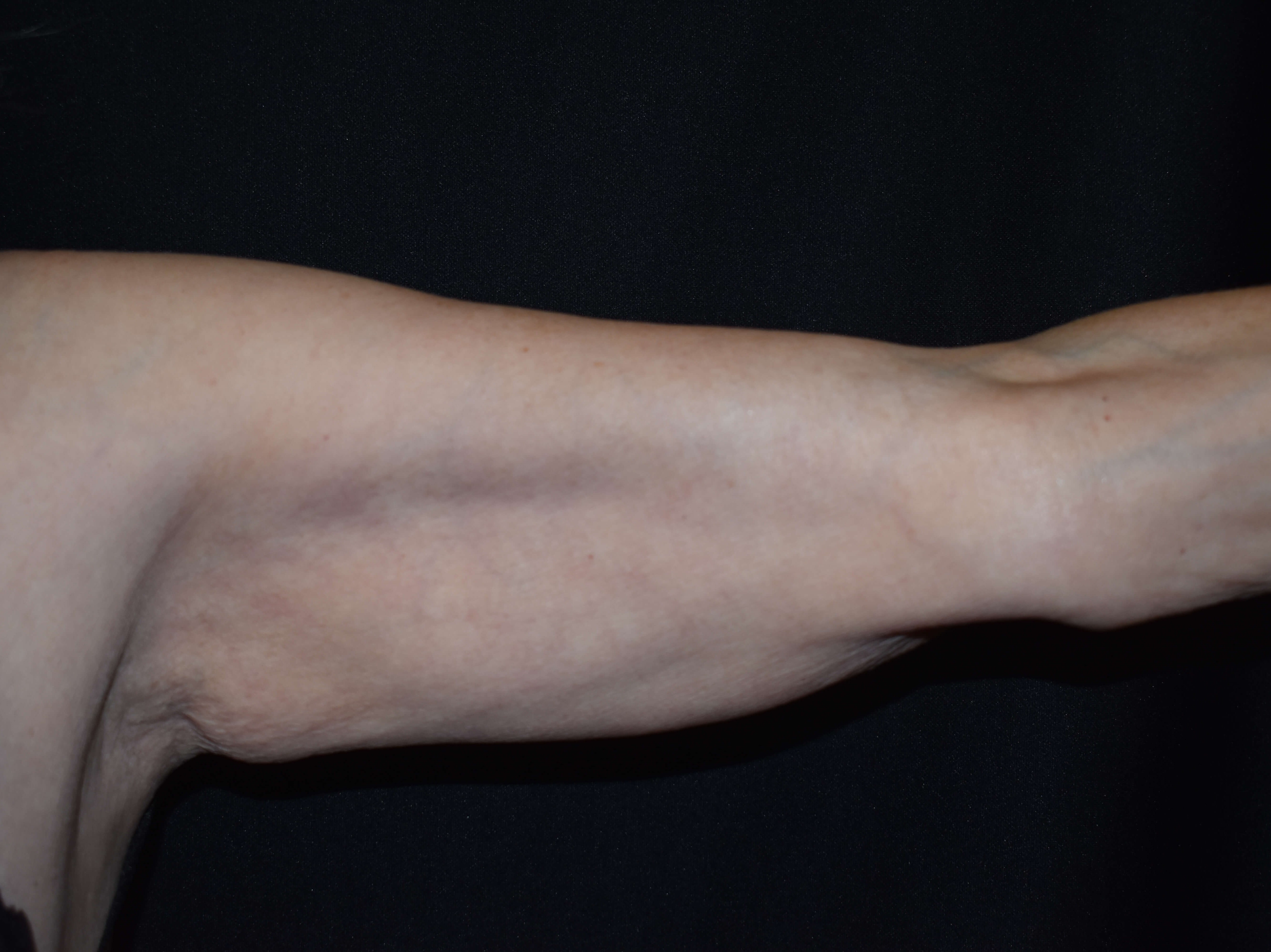 CoolSculpting Arms Before CoolSculpting