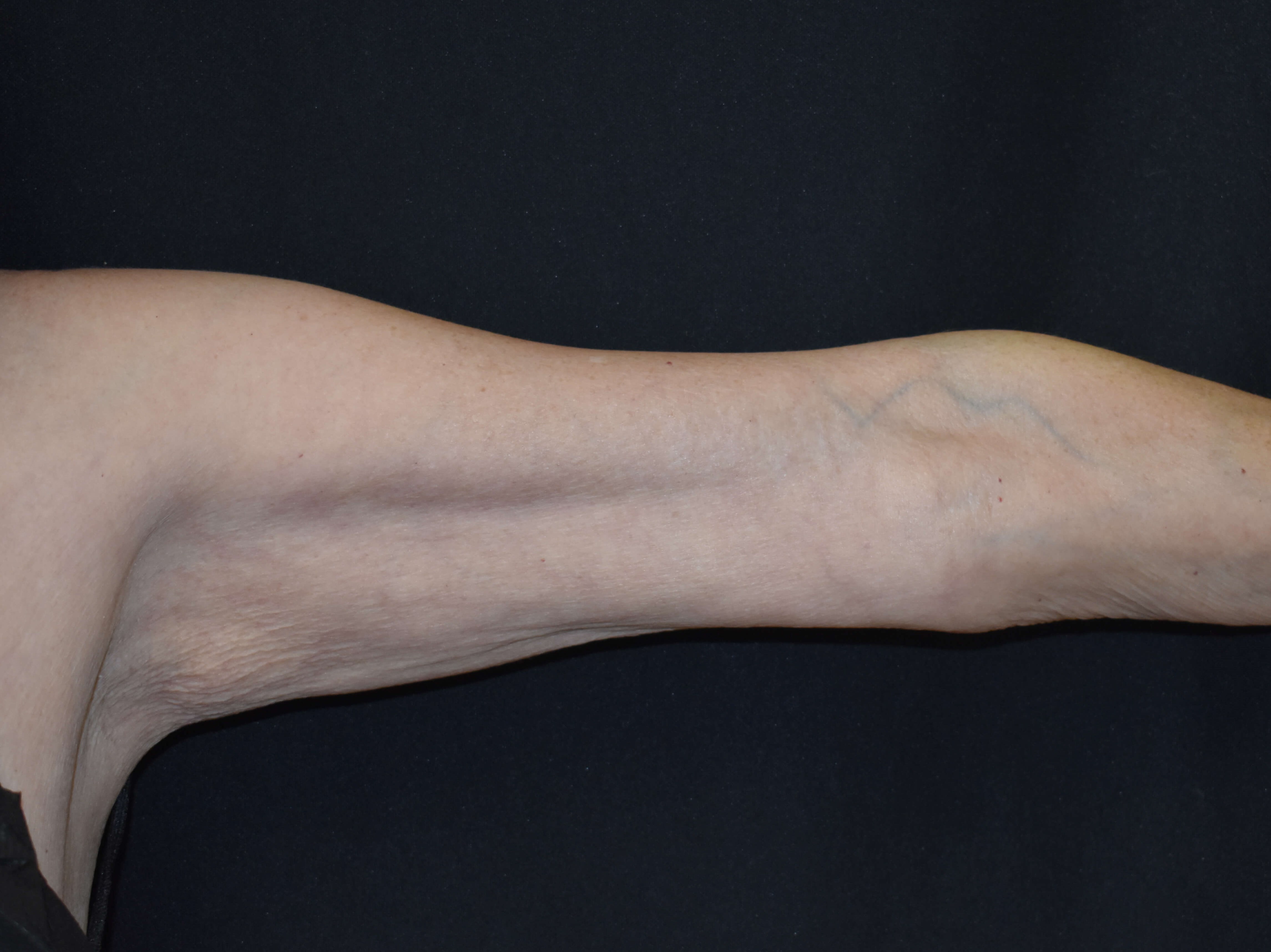 CoolSculpting Arms 3 months After CoolSculpting