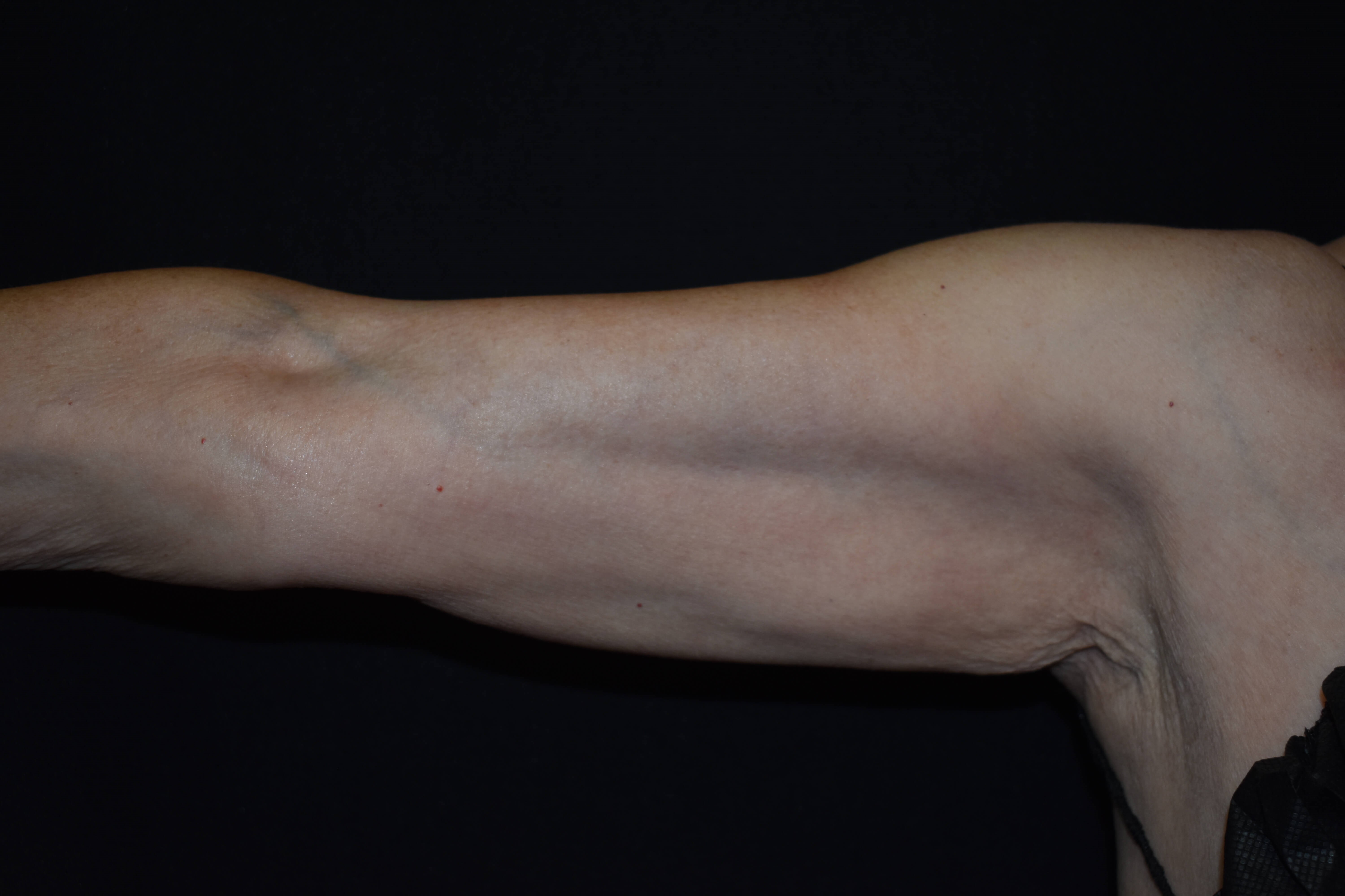Coolsculpting Arms Before CoolSculpting