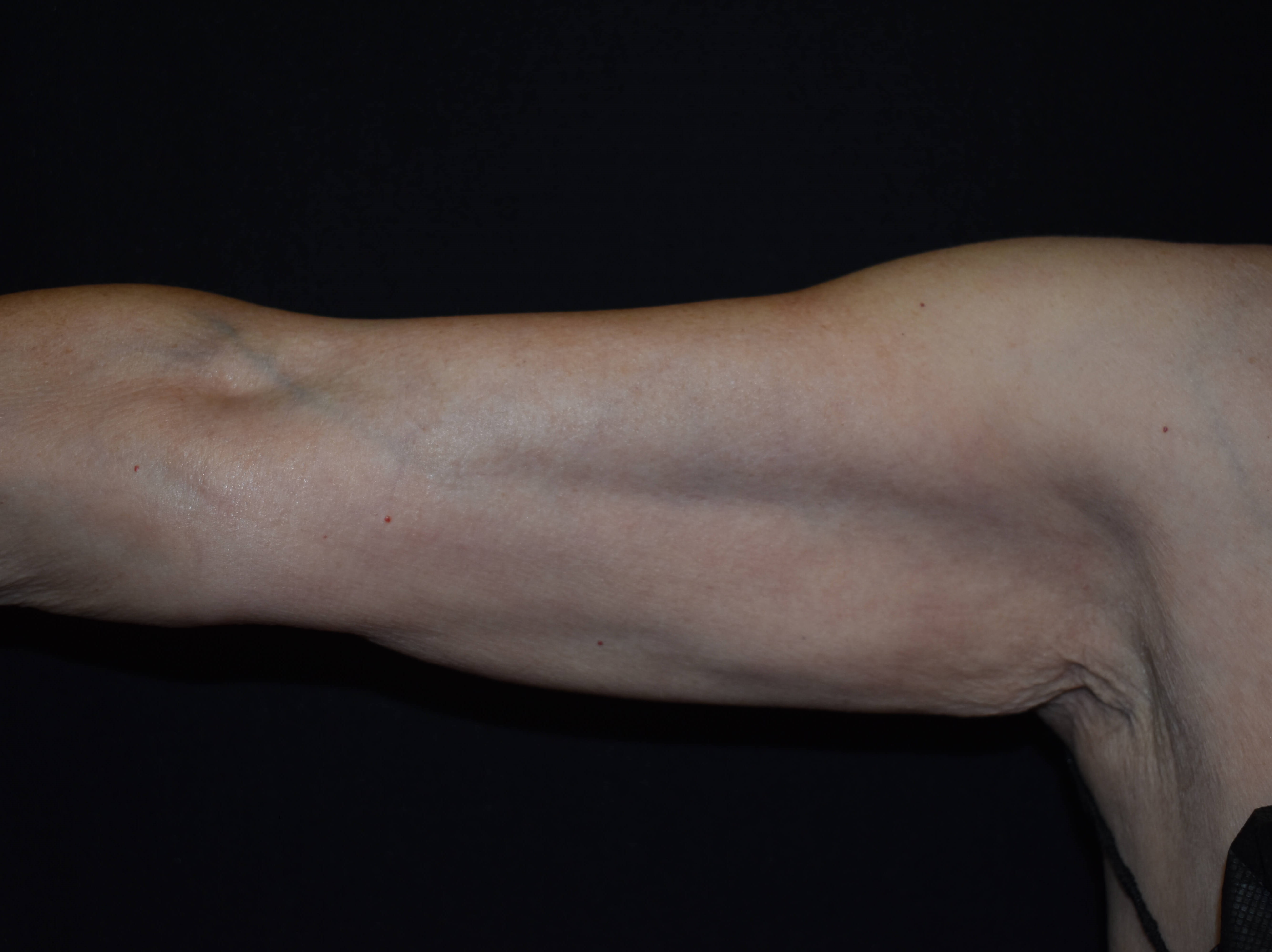Coolsculpting Arms Before CoolSculpting