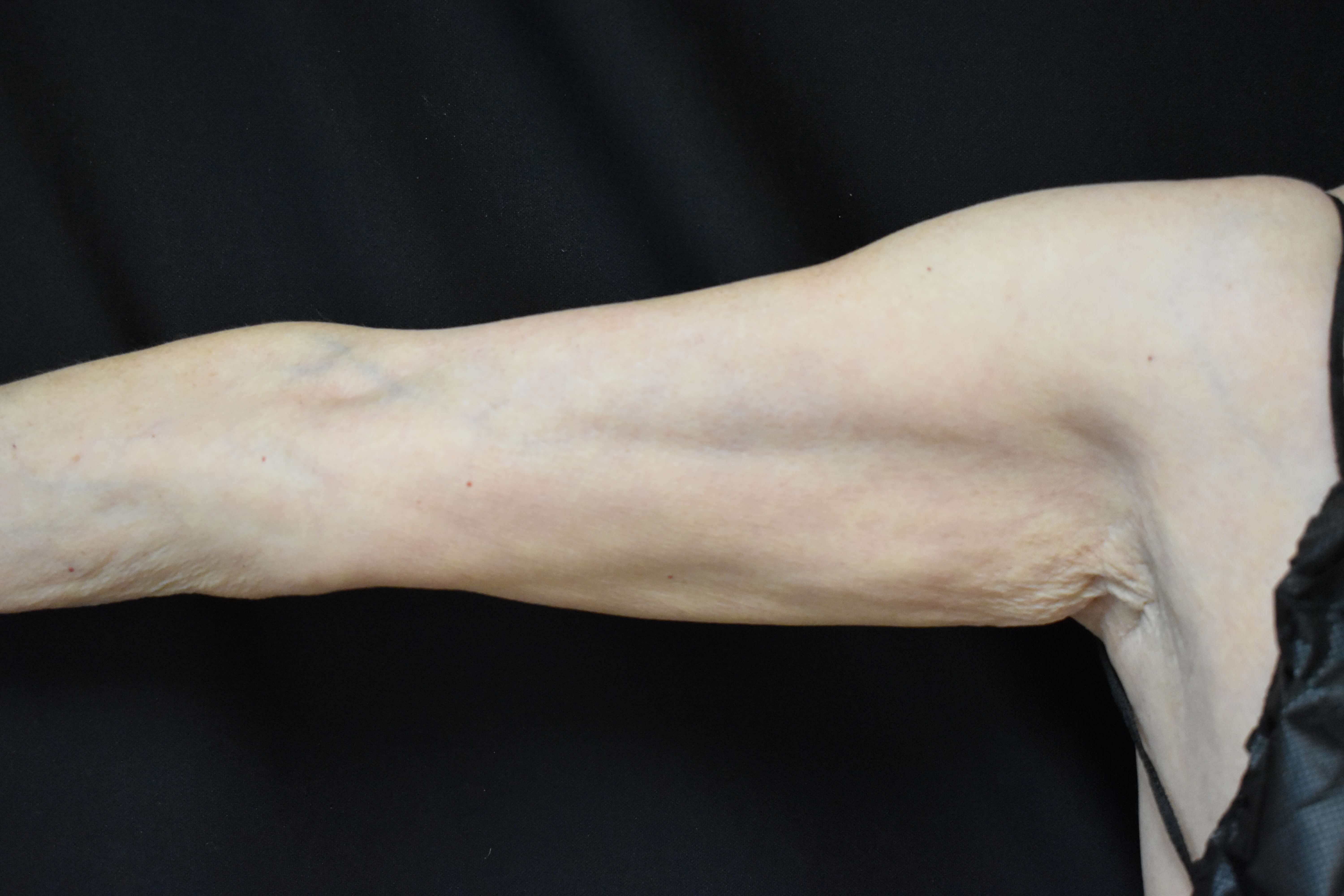 Coolsculpting Arms 3 months After CoolSculpting