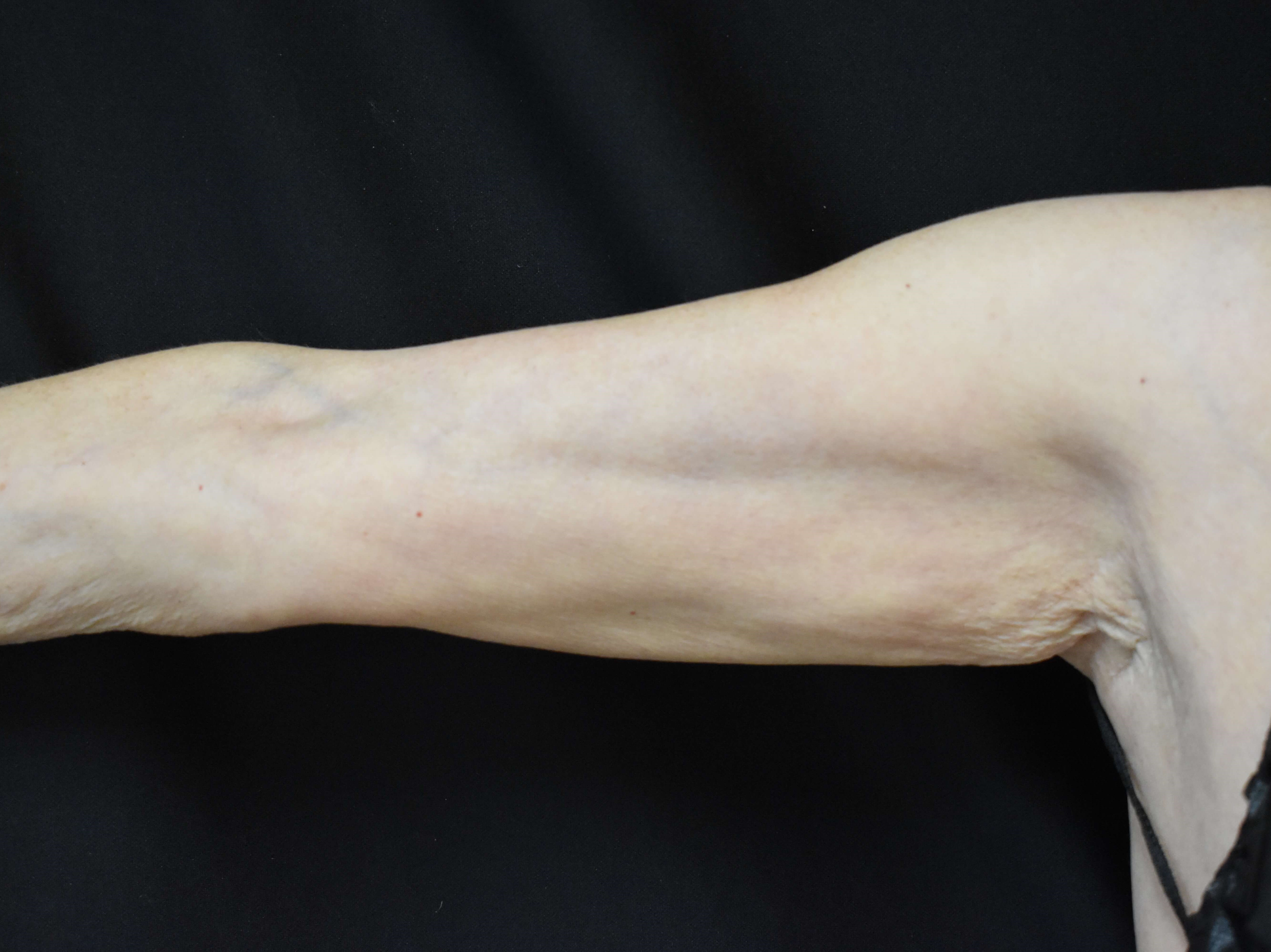 Coolsculpting Arms 3 months After CoolSculpting