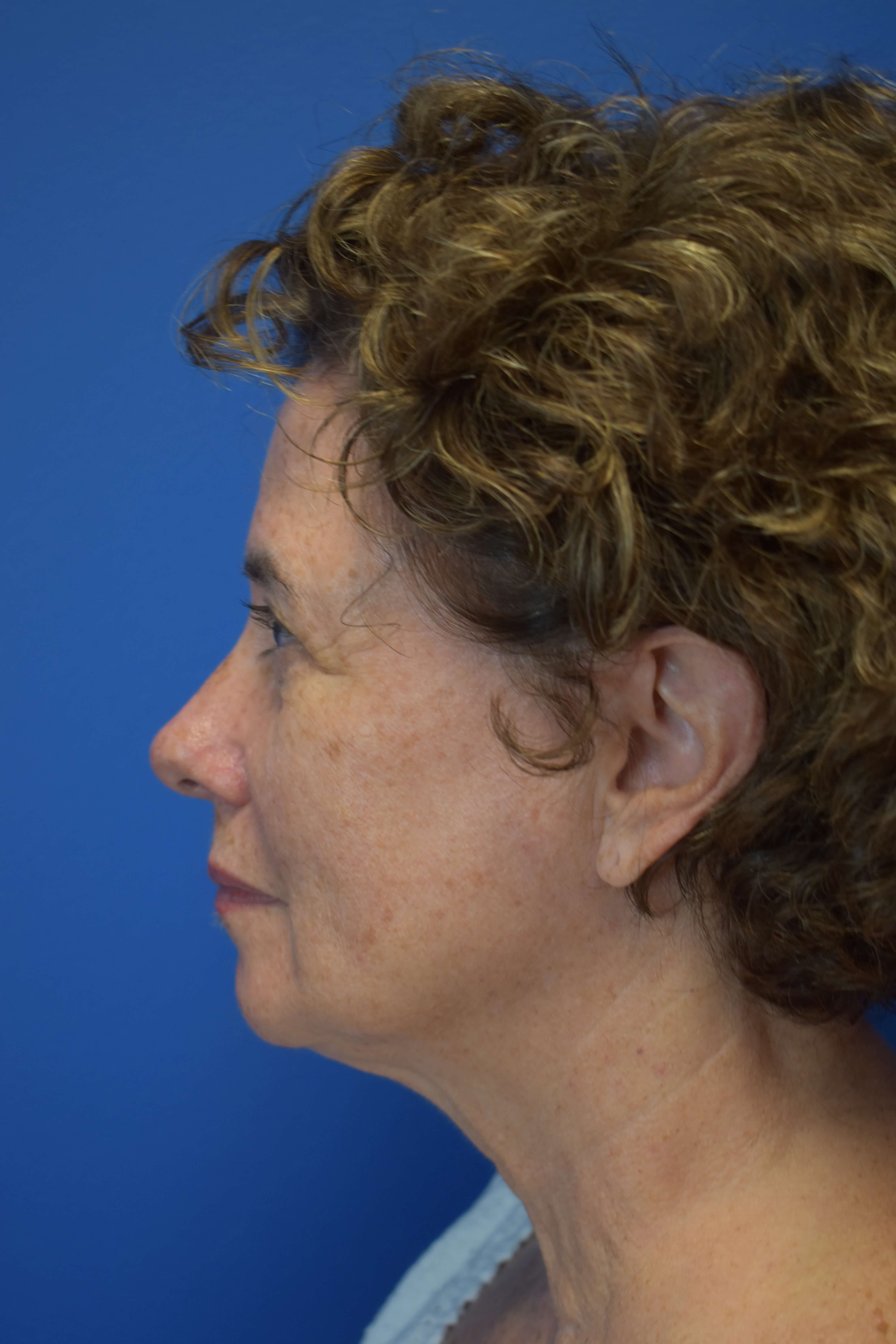 Broad Band Light Treatment Before