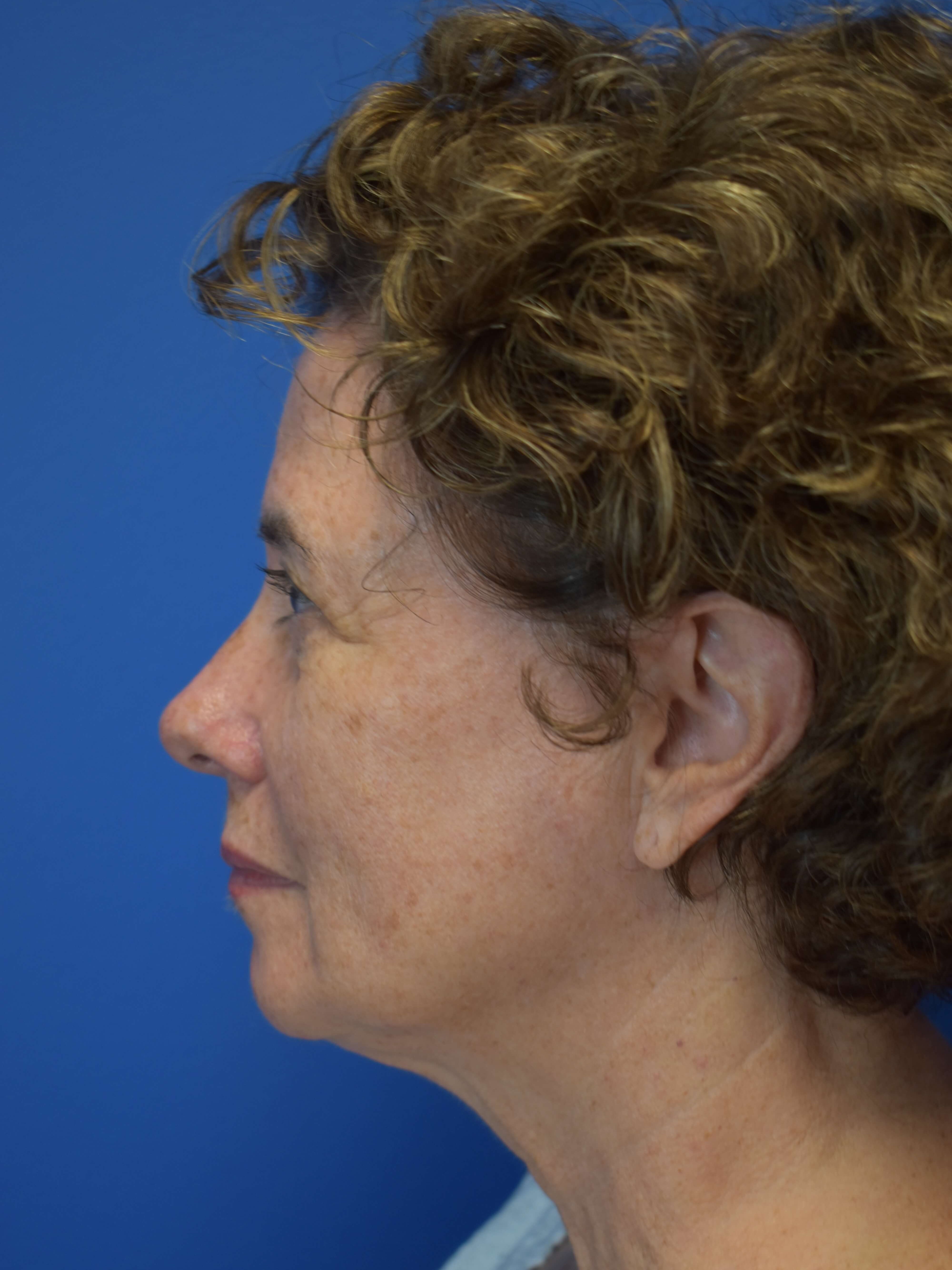 Broad Band Light Treatment Before
