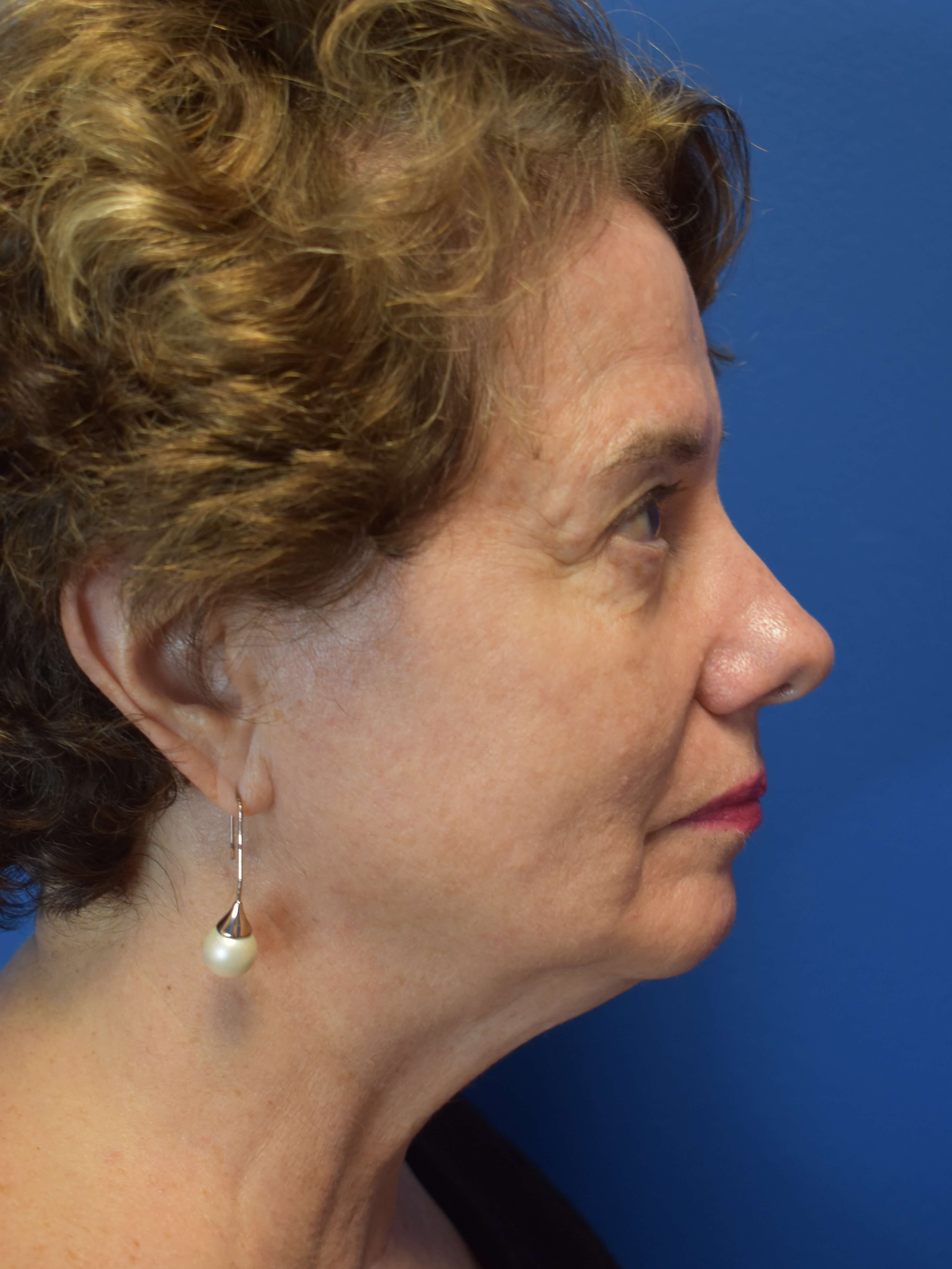 BroadBand Light Treatment After 3 treatments