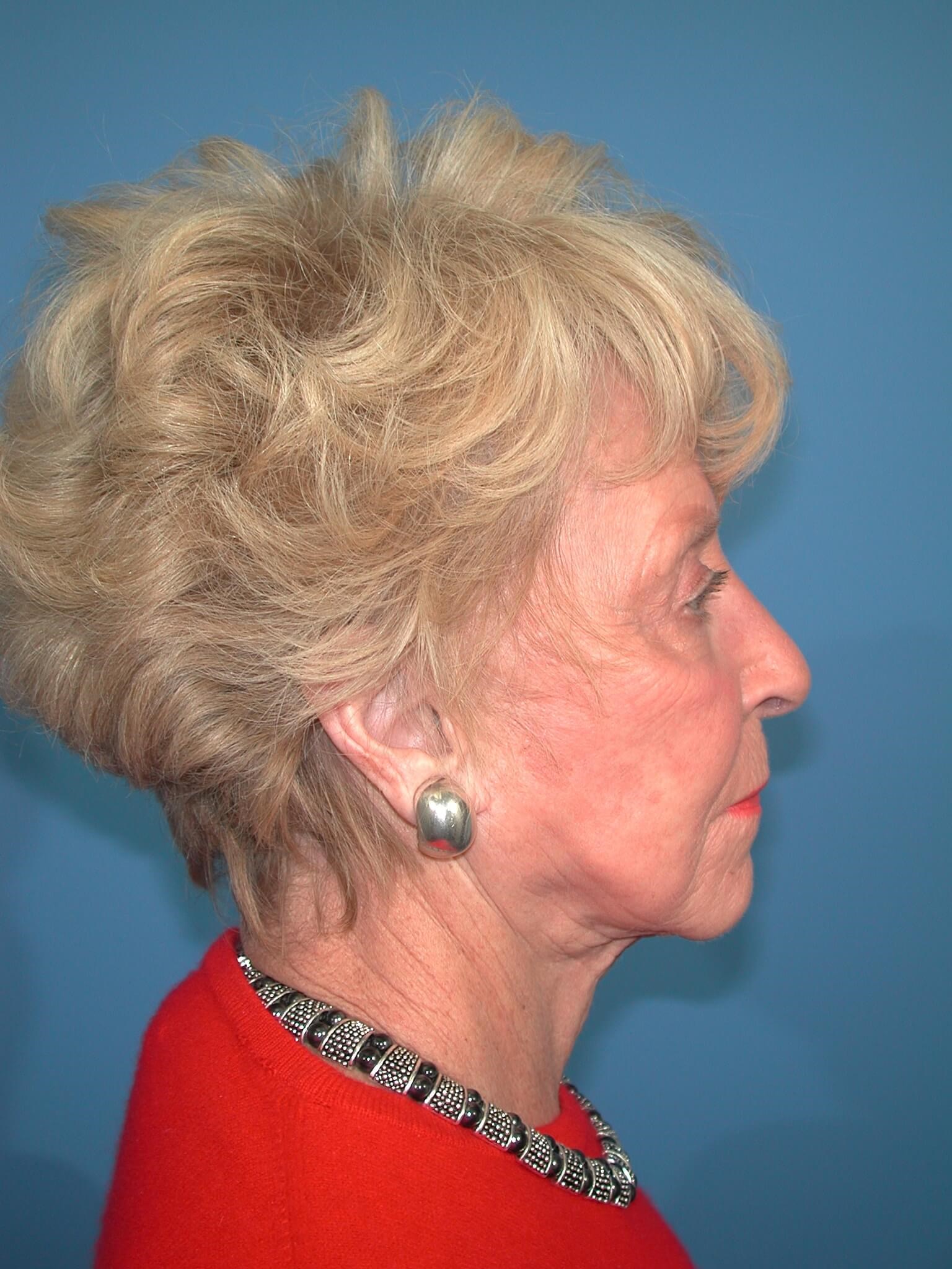 Right - Lateral Before Face Lift
