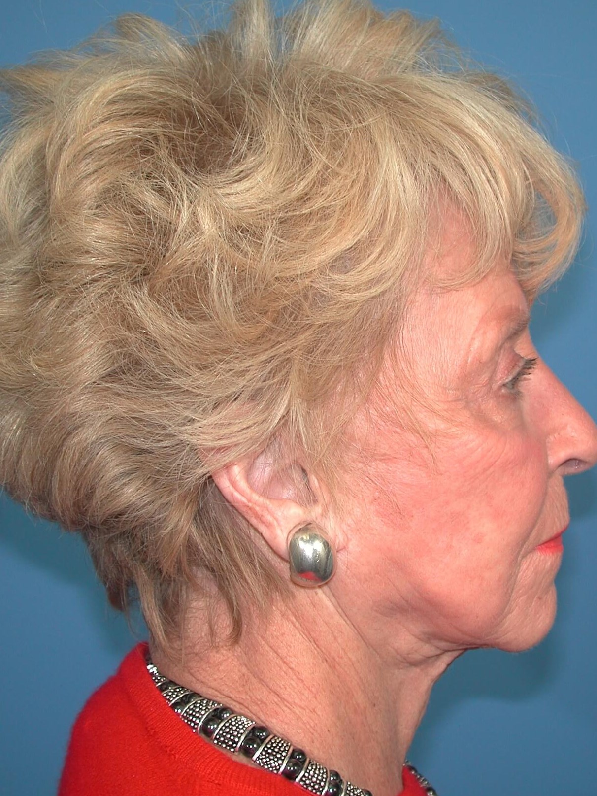 Right - Lateral Before Face Lift