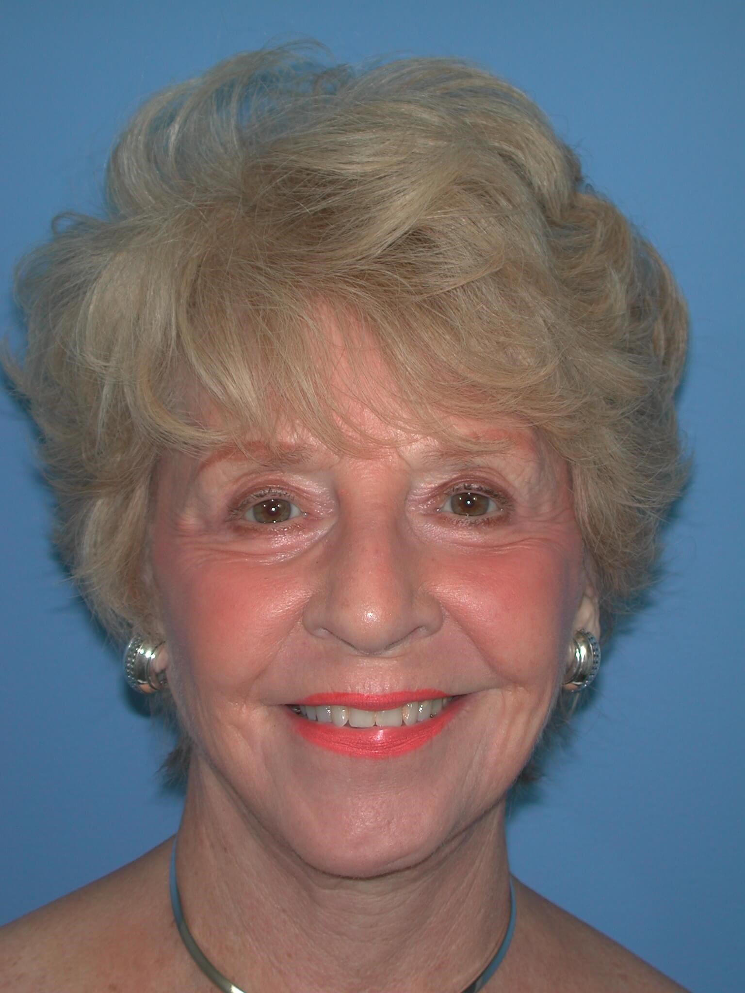 Front After Face Lift