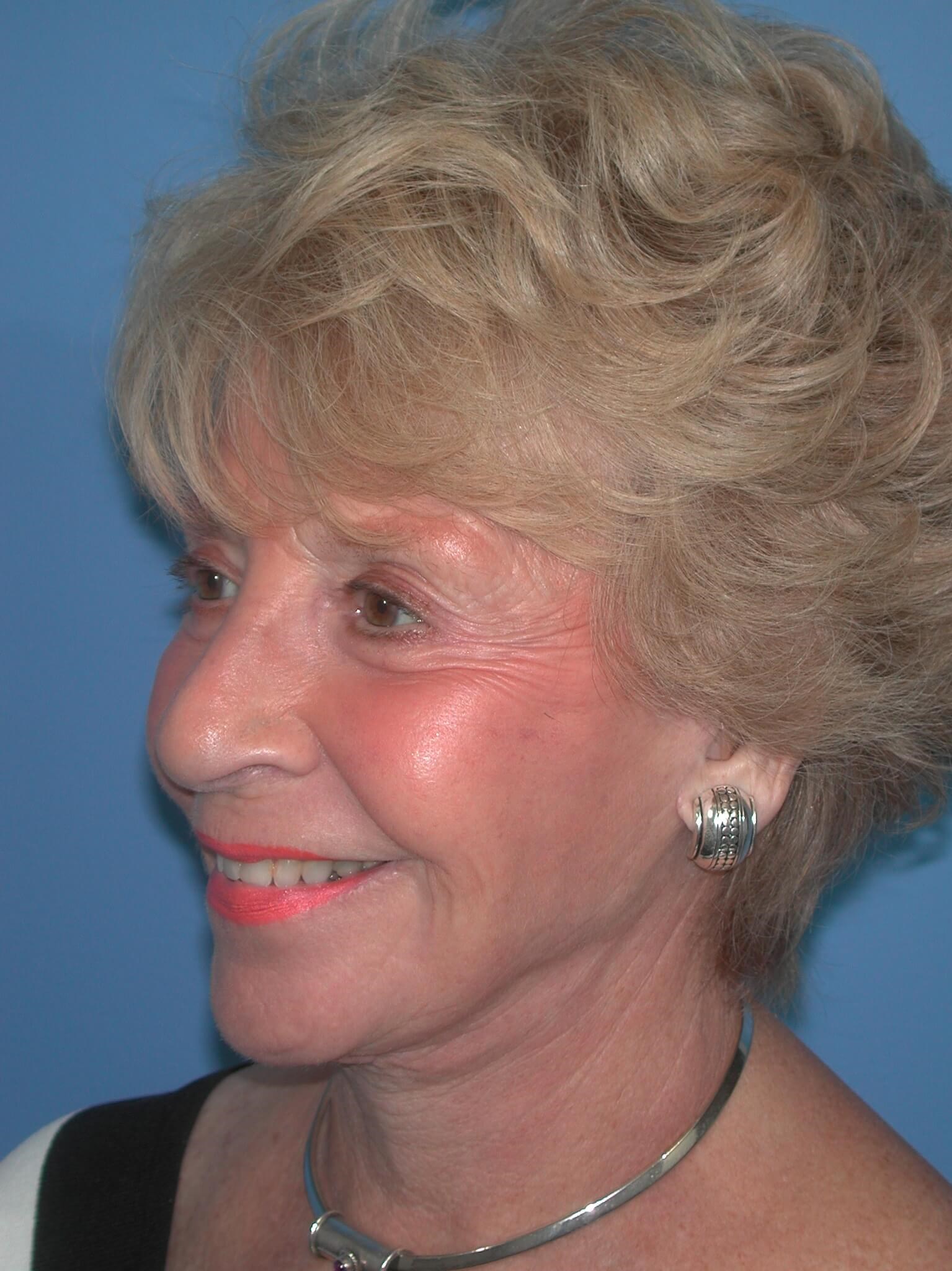 Left - Oblique After Face Lift