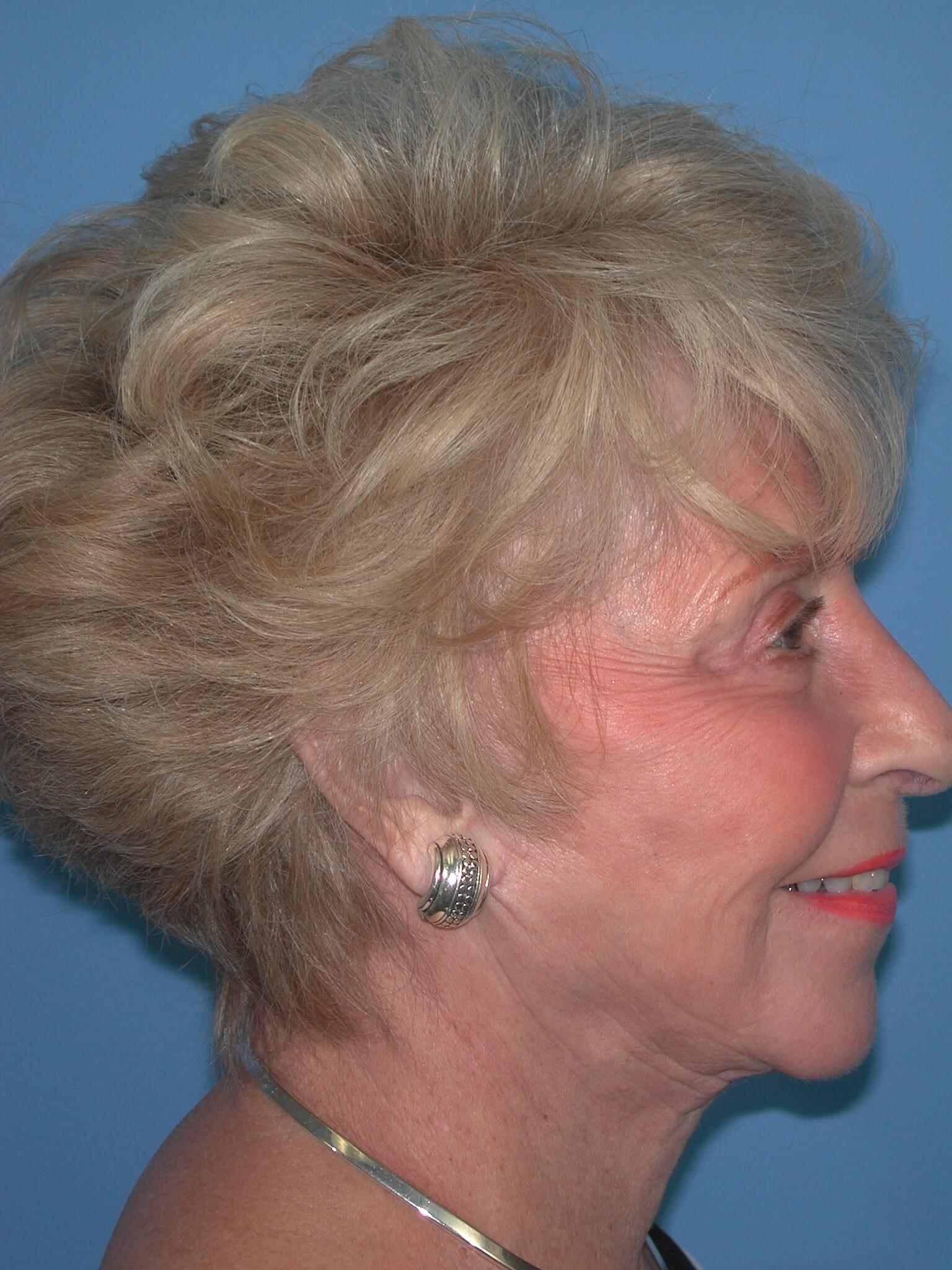 Right - Lateral After Face Lift