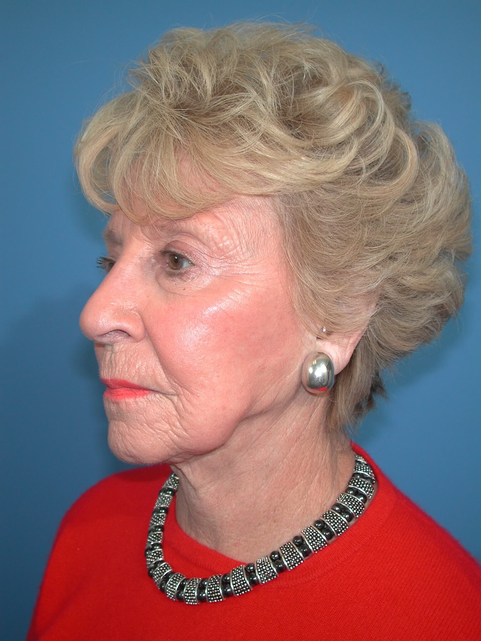Left - Oblique Before Face Lift