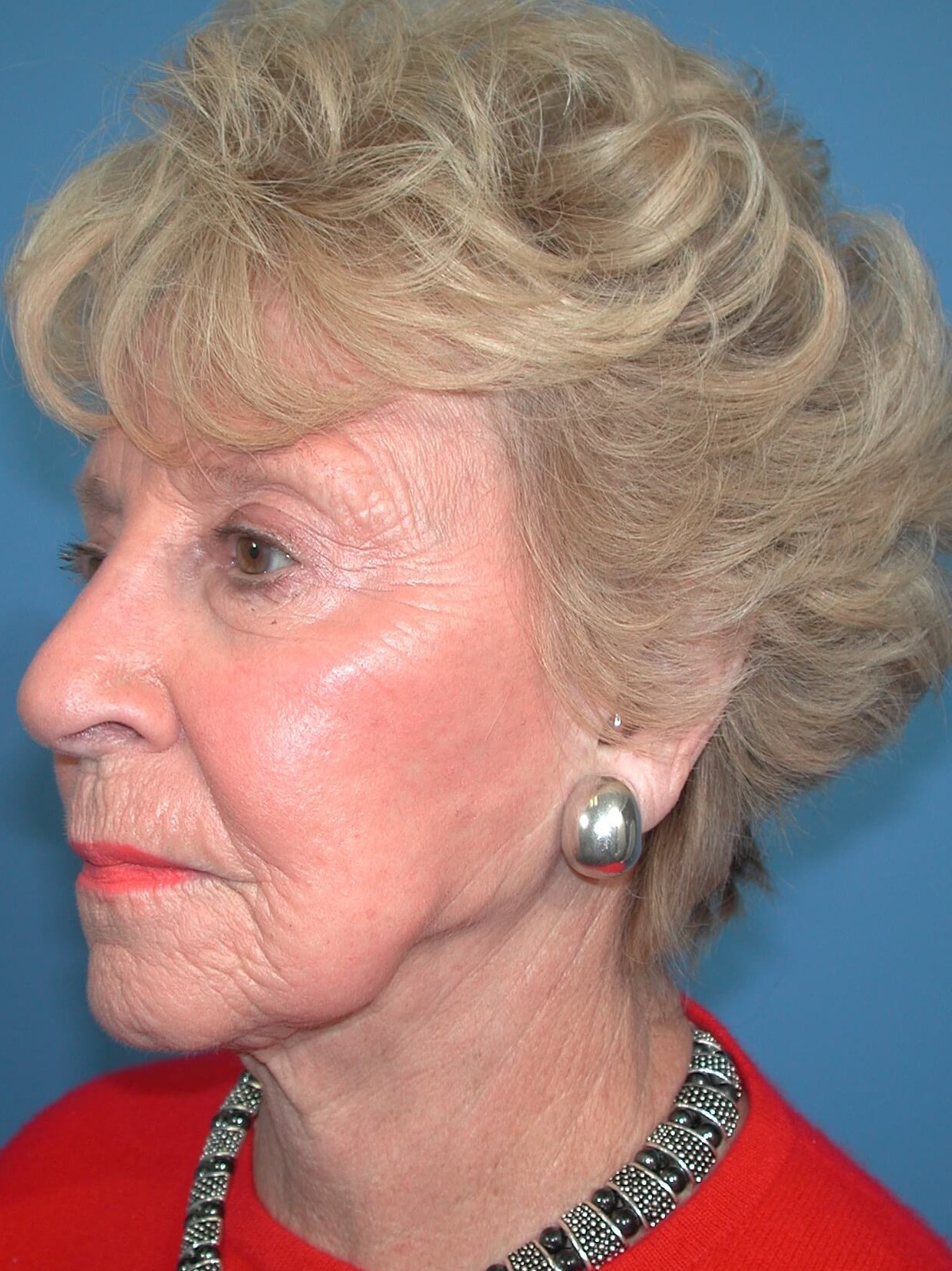 Left - Oblique Before Face Lift
