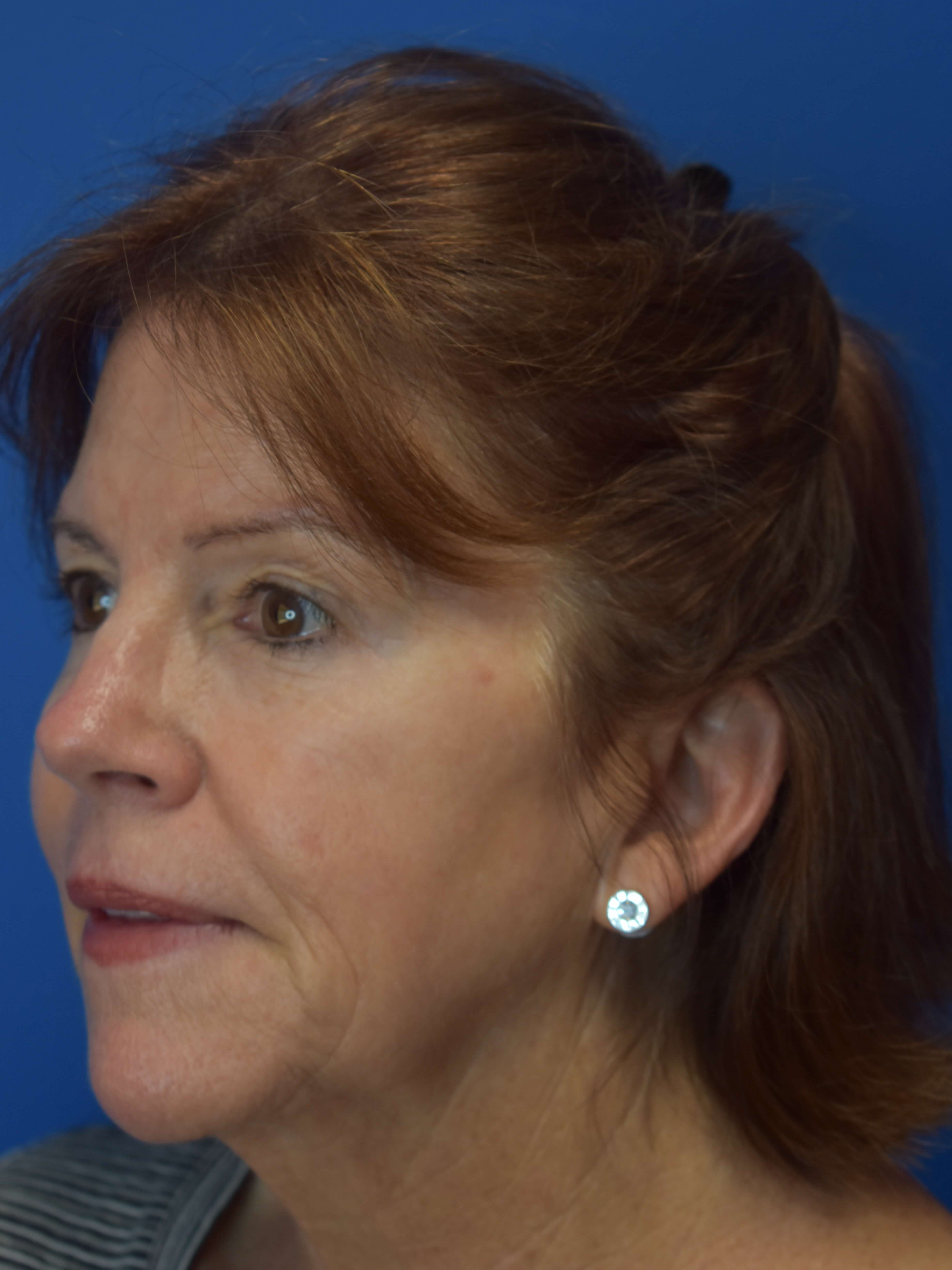Broad Band Light HERO After 3rd treatment