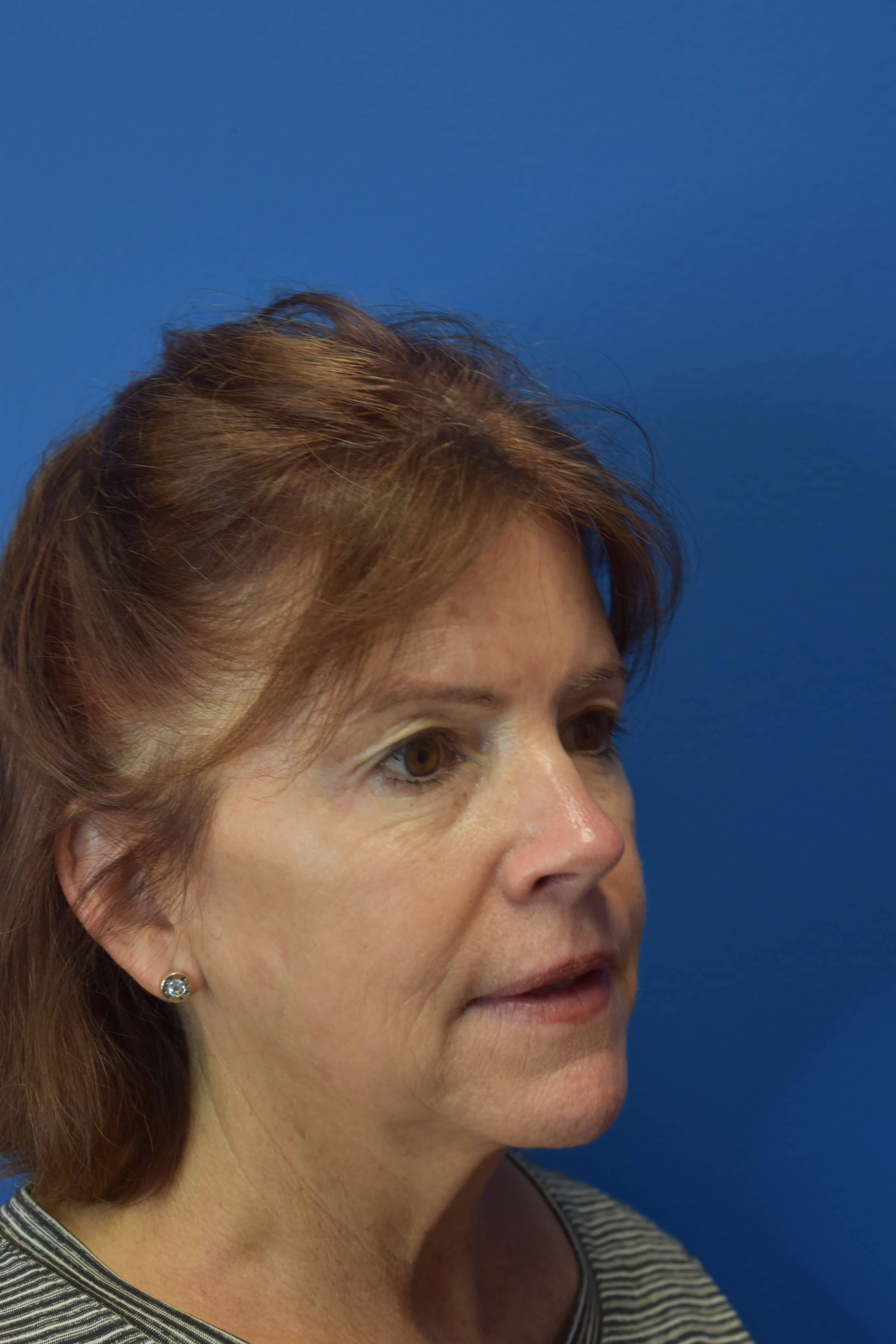 Broad Band Light HERO After 3 treatments