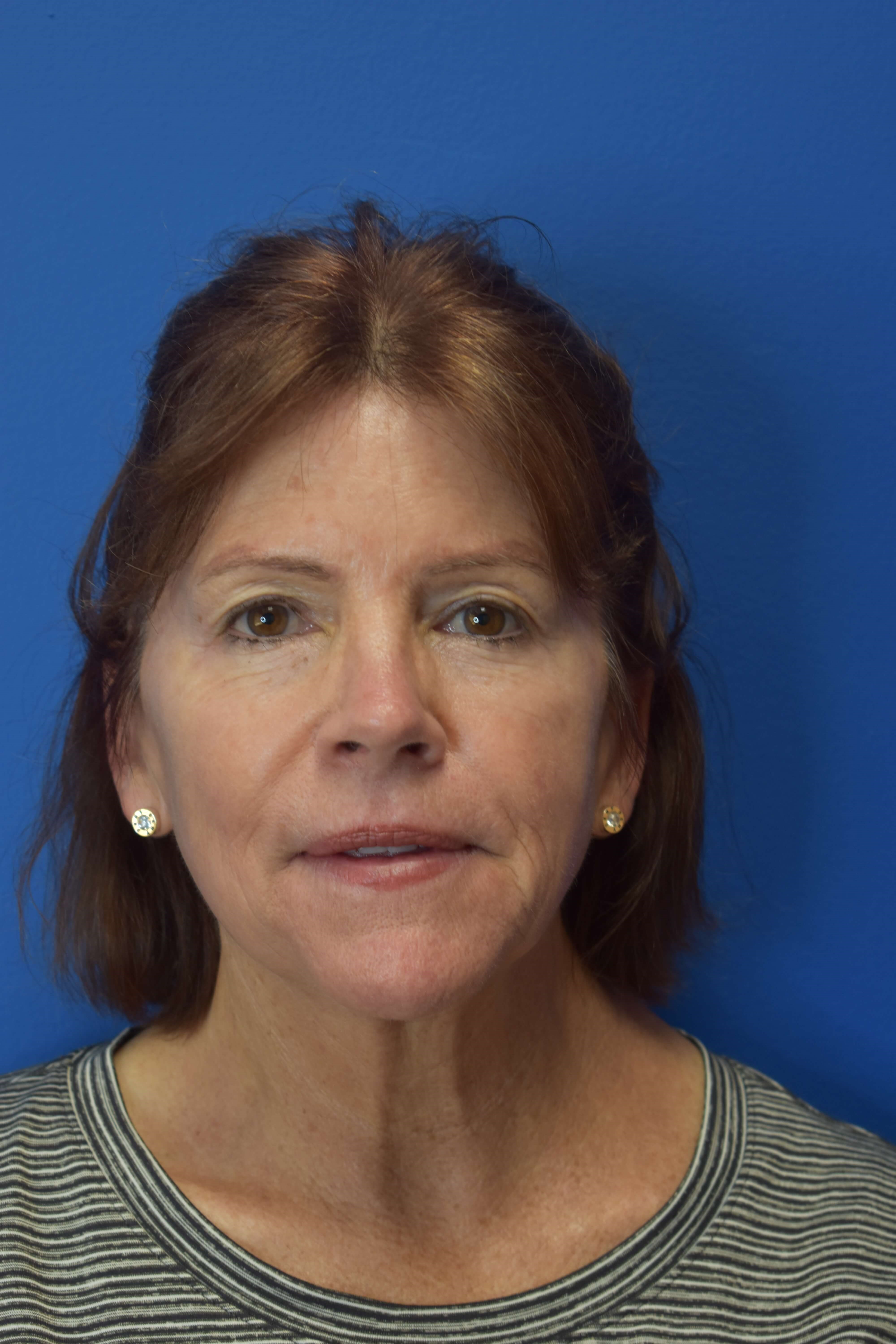 Broad Band Light HERO After 3 treatments