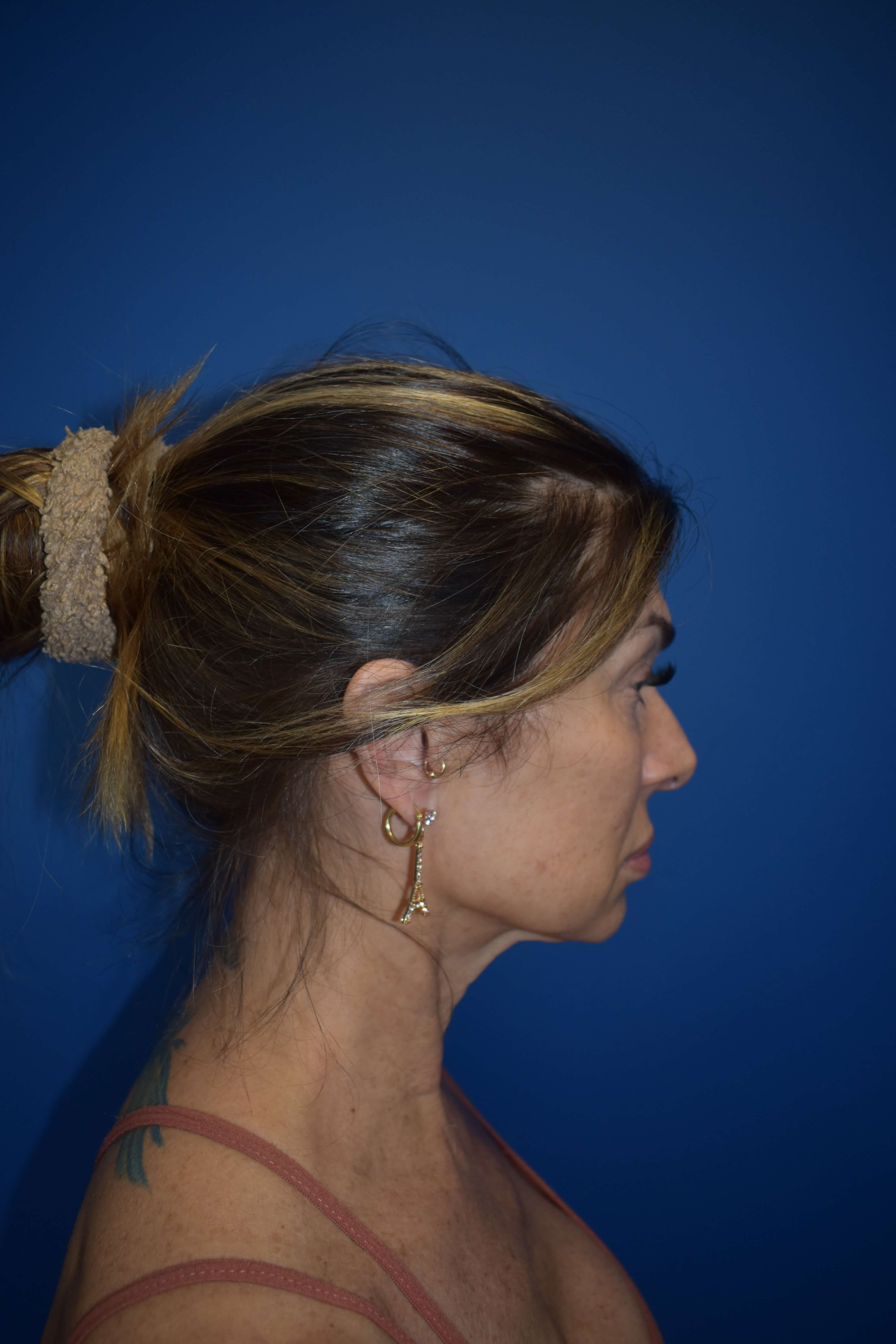 Lateral Before