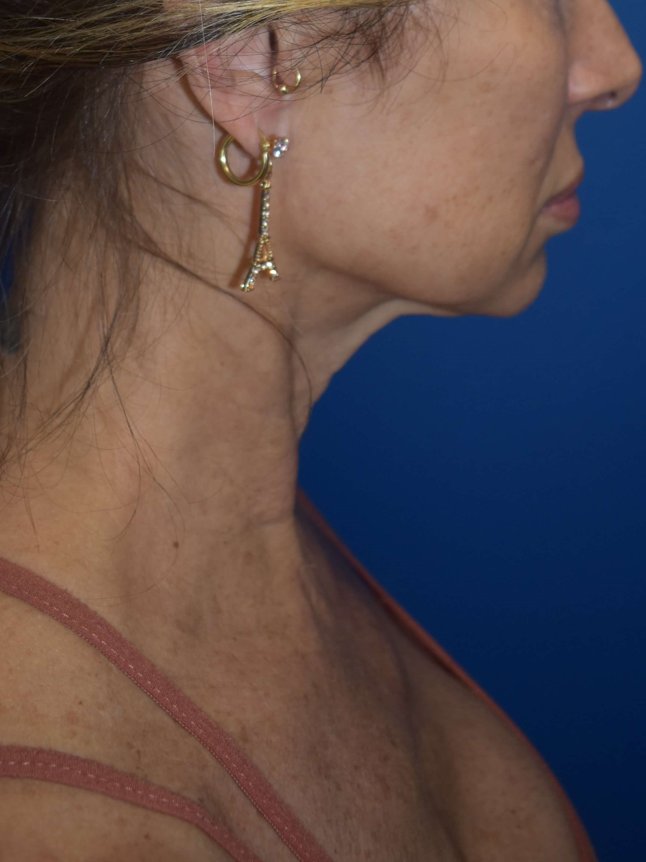 Lateral Before