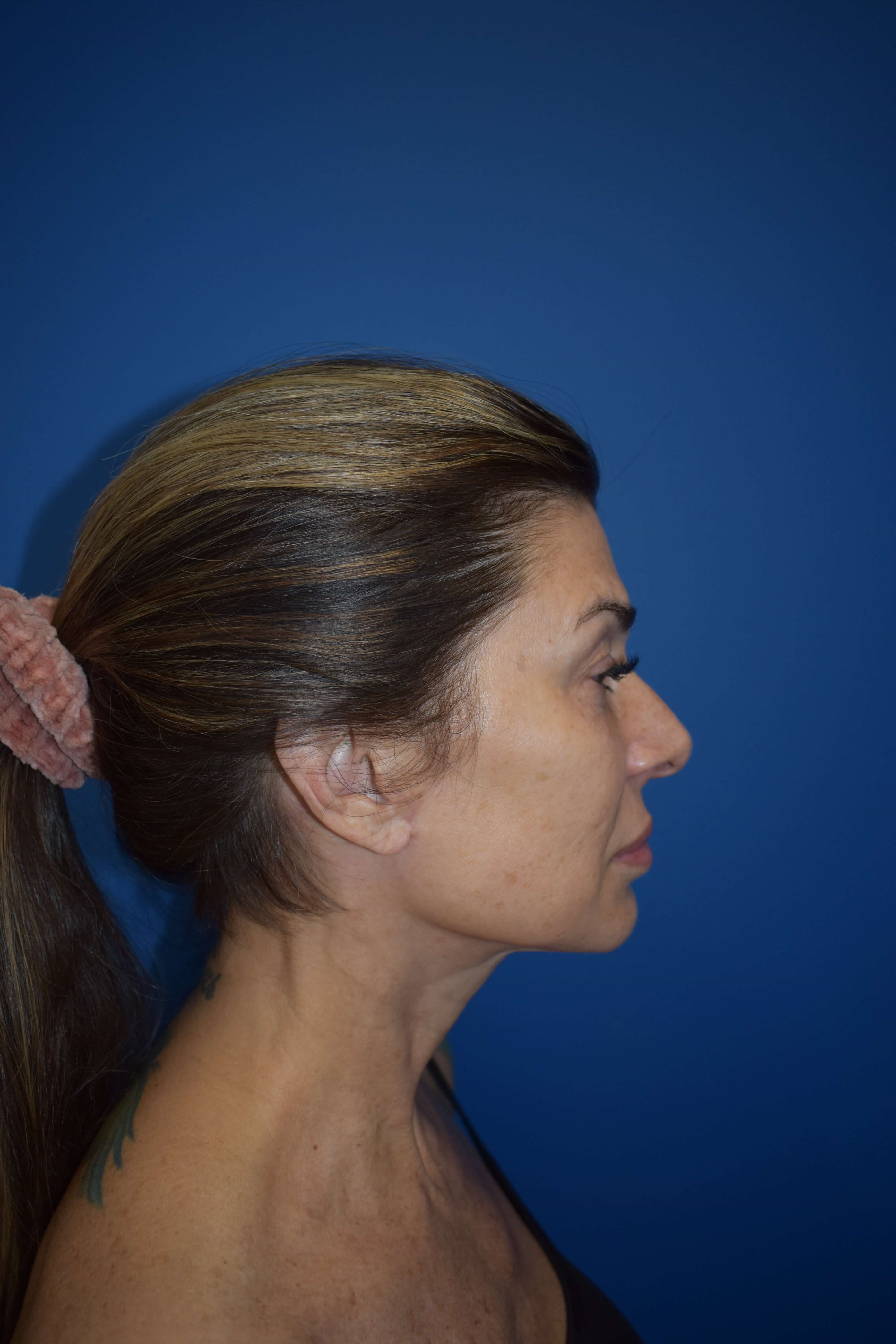 Lateral After