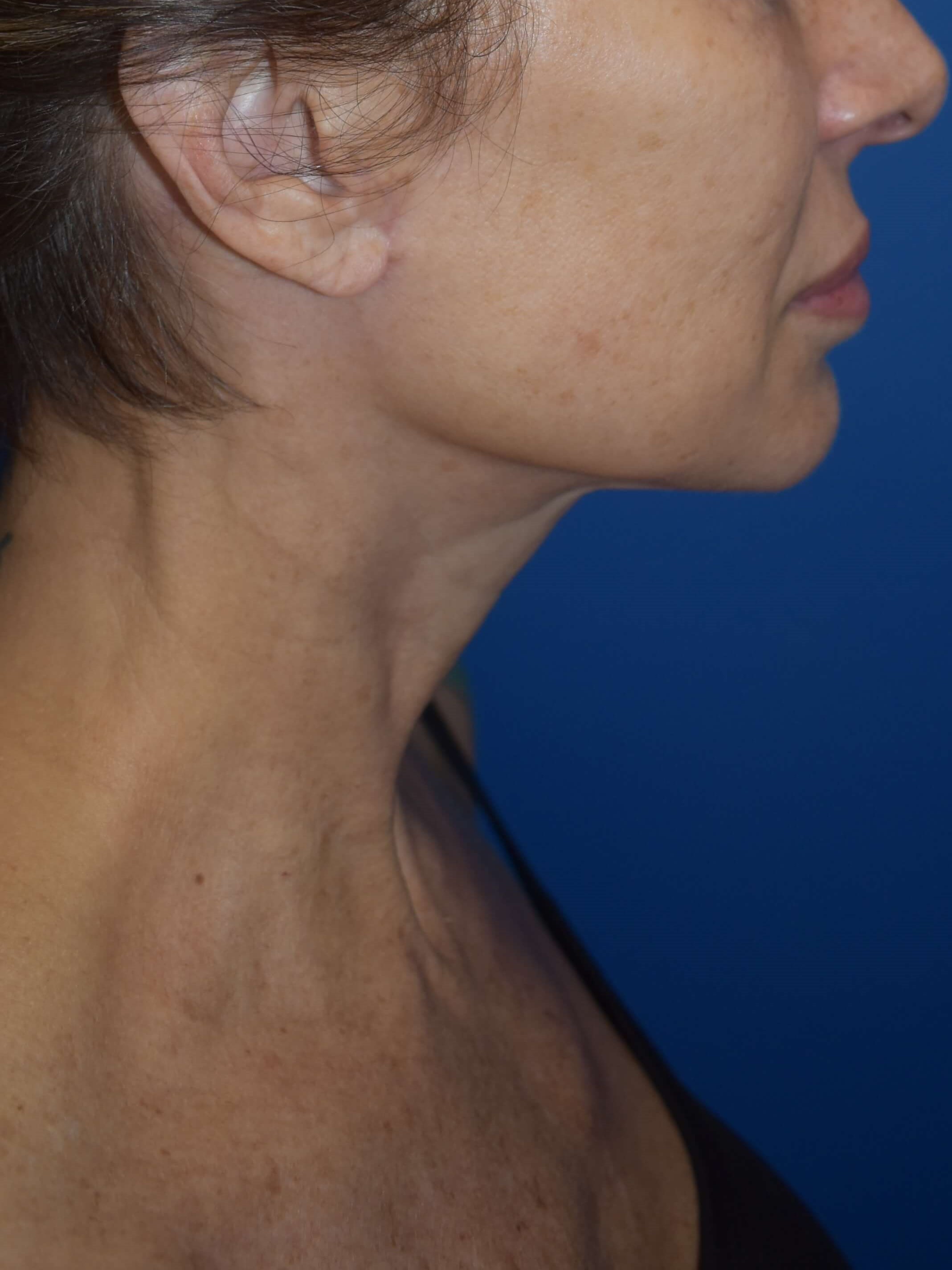 Lateral After