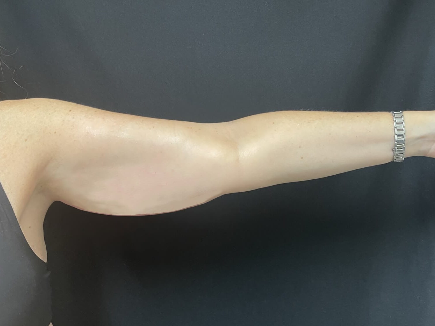 CoolSculpting Arms Before