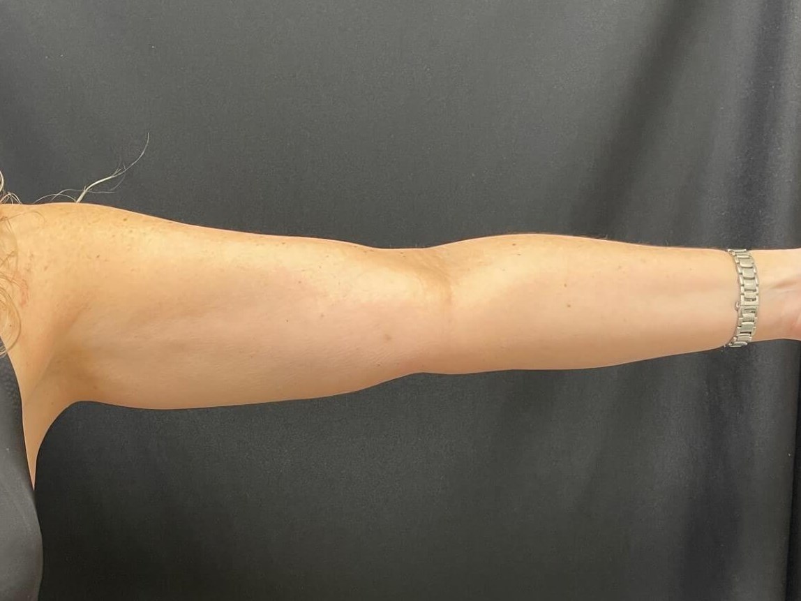 CoolSculpting Arms After