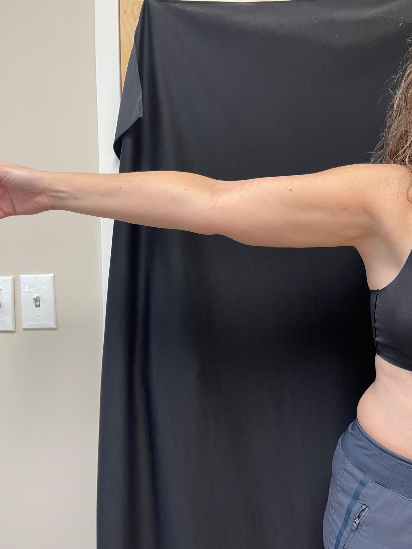 CoolSculpting Arms After