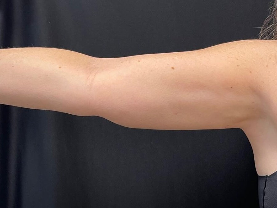 CoolSculpting Arms After