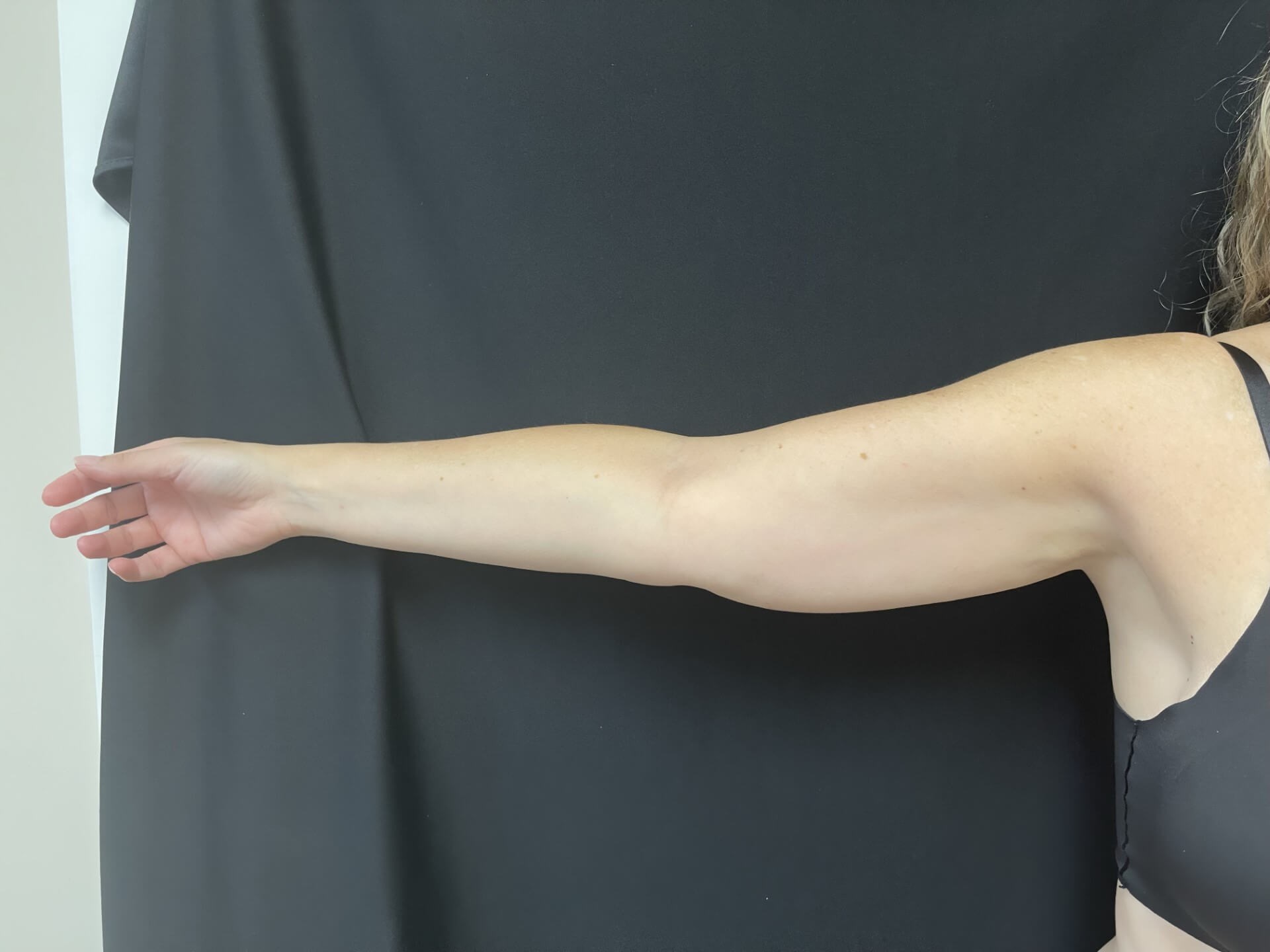 CoolSculpting Arms Before