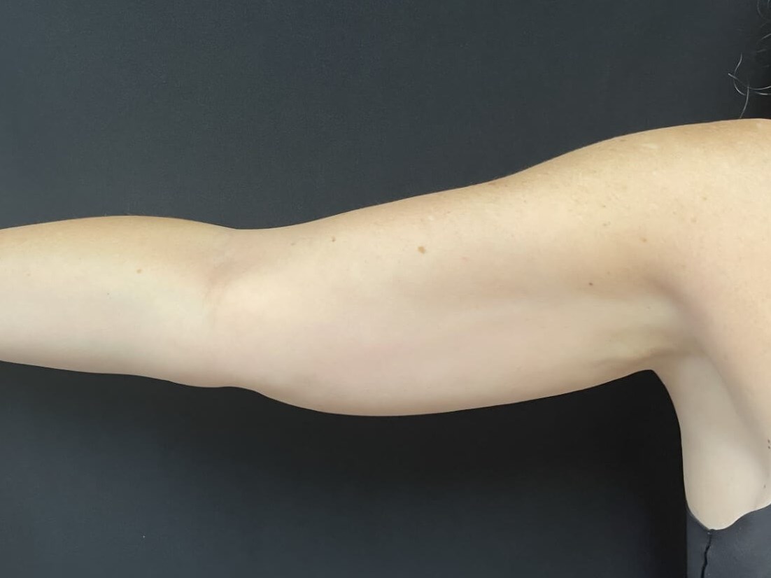 CoolSculpting Arms Before