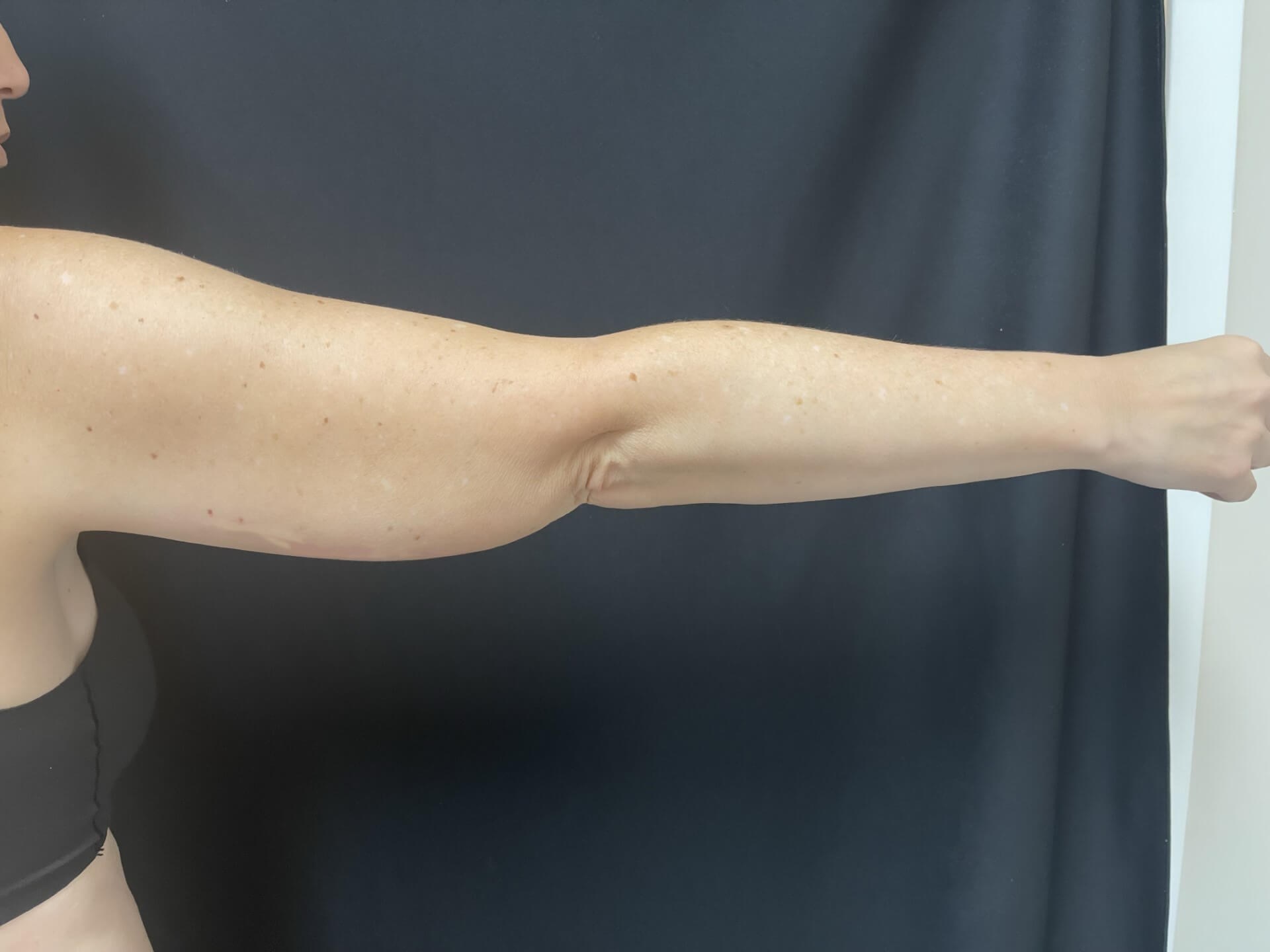 CoolSculpting Arms Before