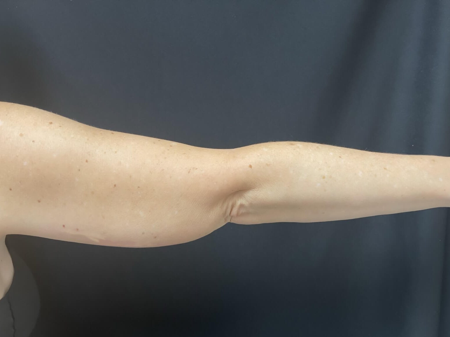 CoolSculpting Arms Before