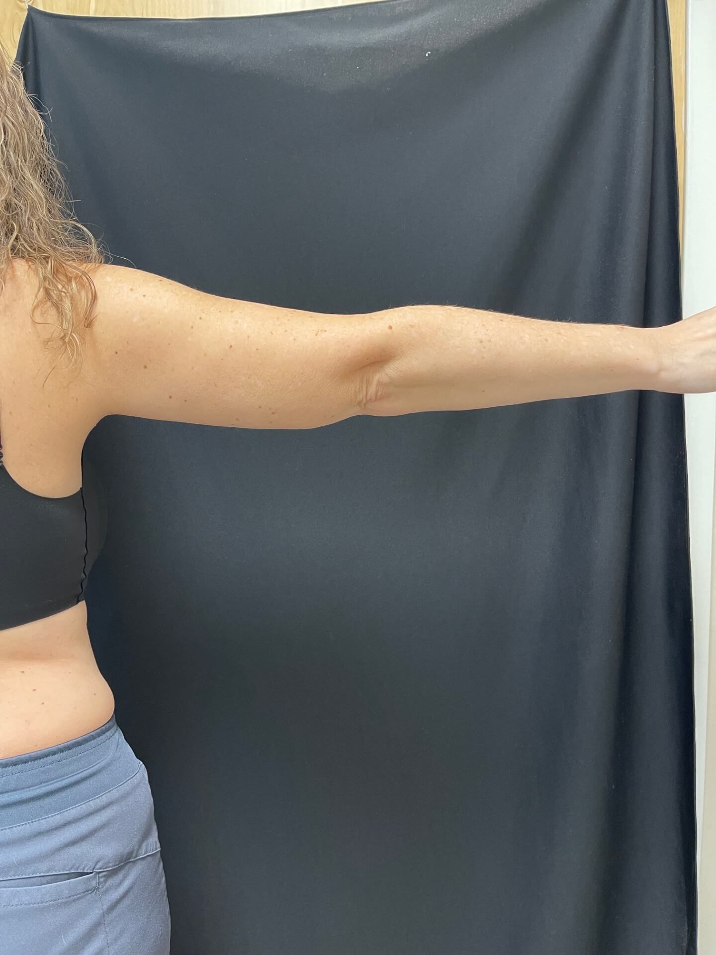 CoolSculpting Arms After