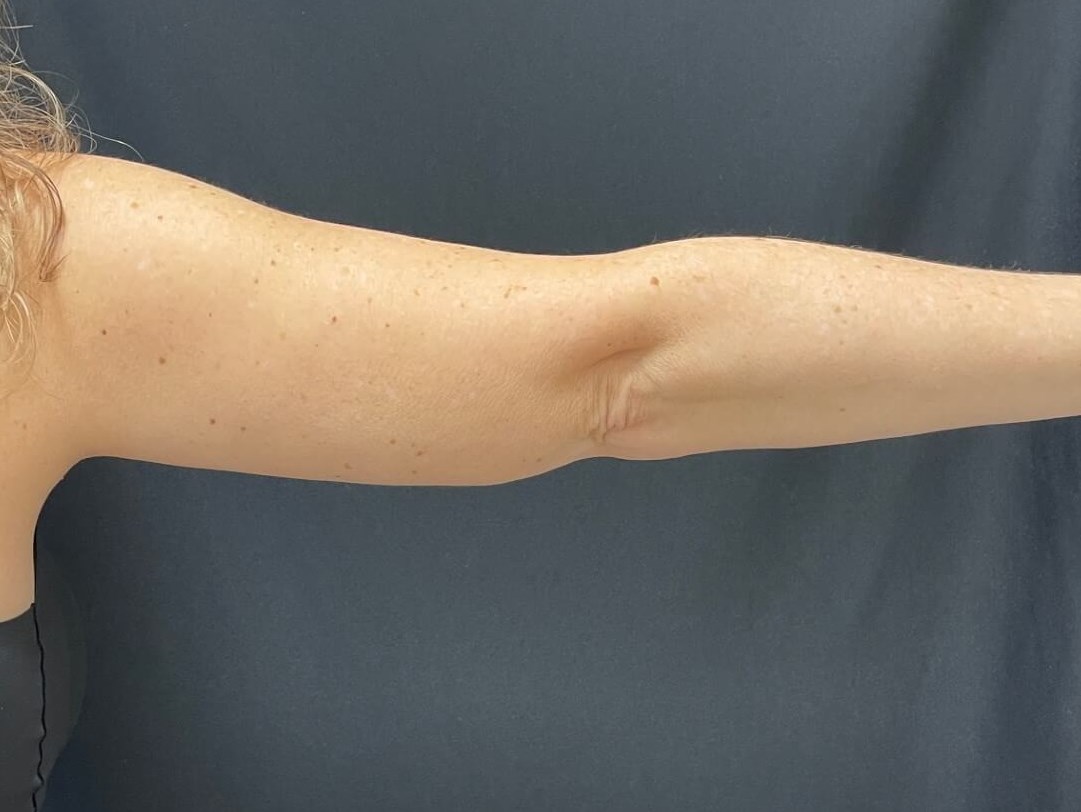 CoolSculpting Arms After