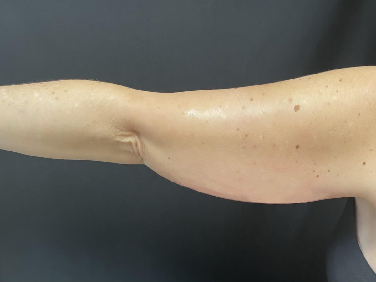 CoolSculpting Arms Before
