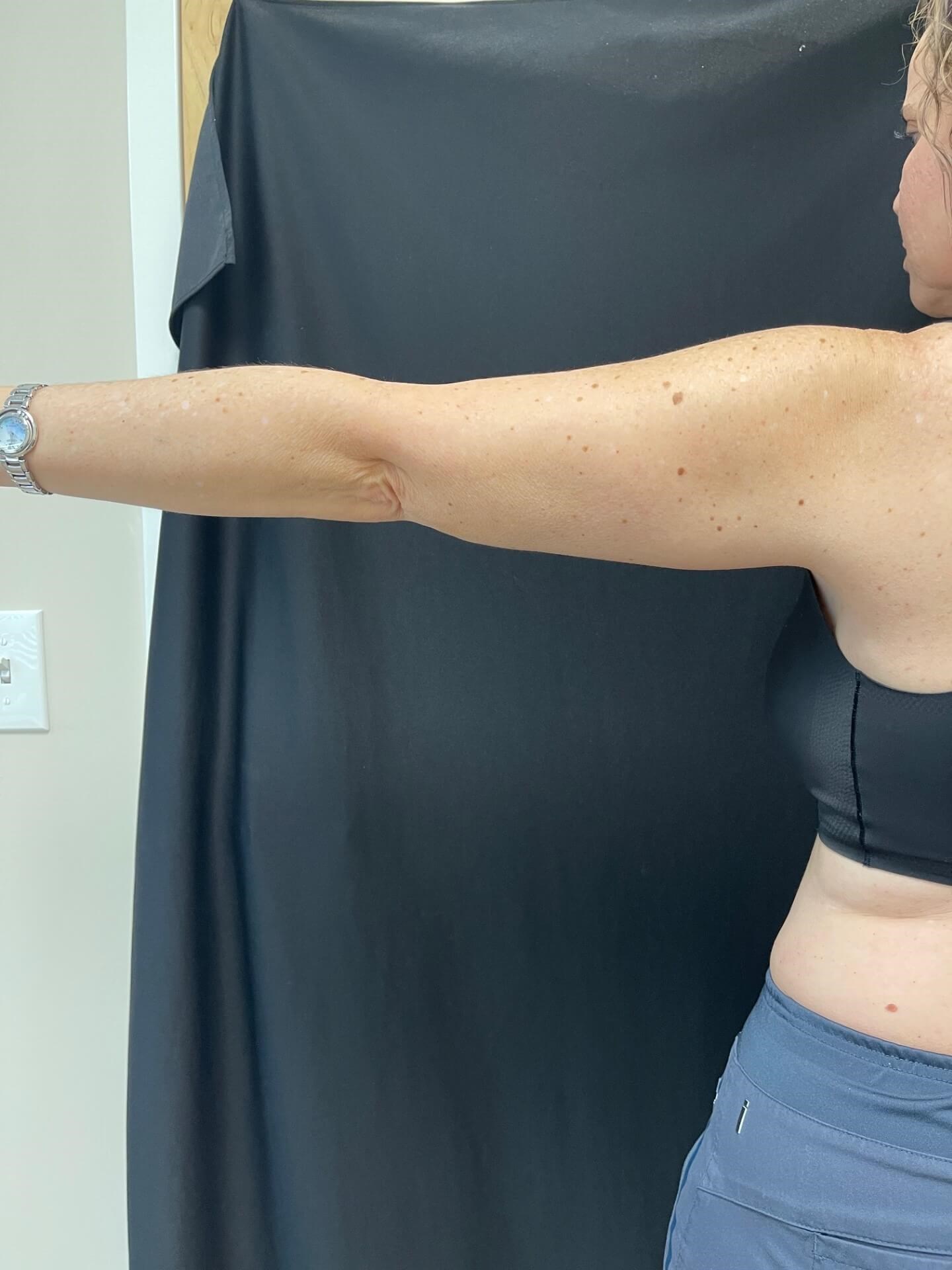 CoolSculpting Arms After