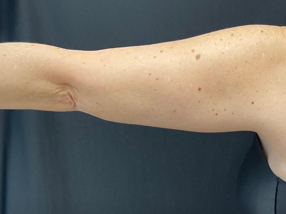 CoolSculpting Arms After