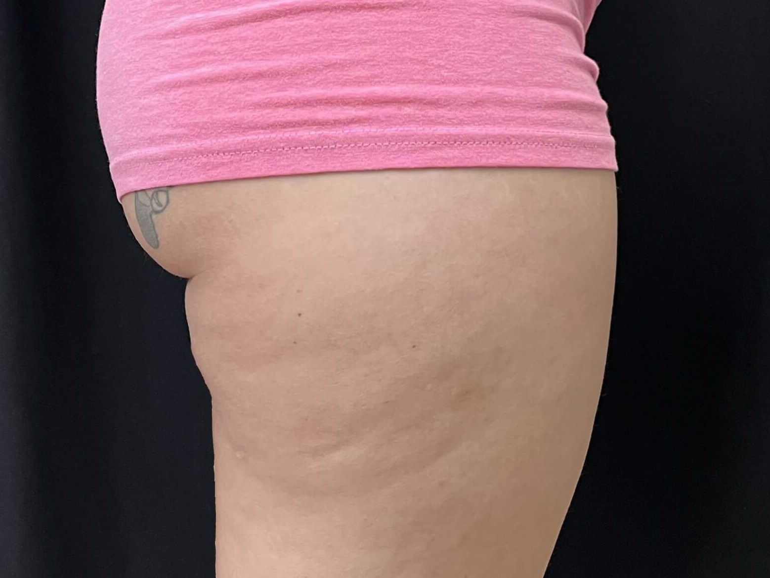 CoolSculpting Banana roll Before