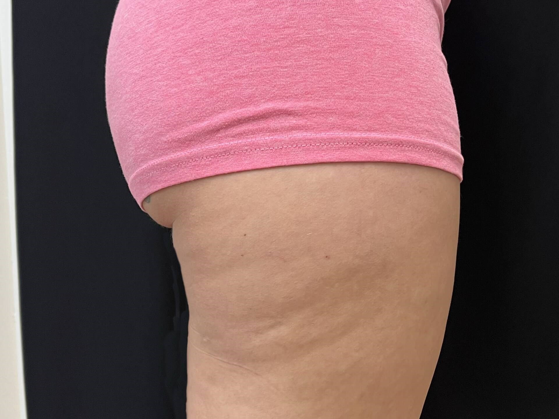 CoolSculpting Banana roll After