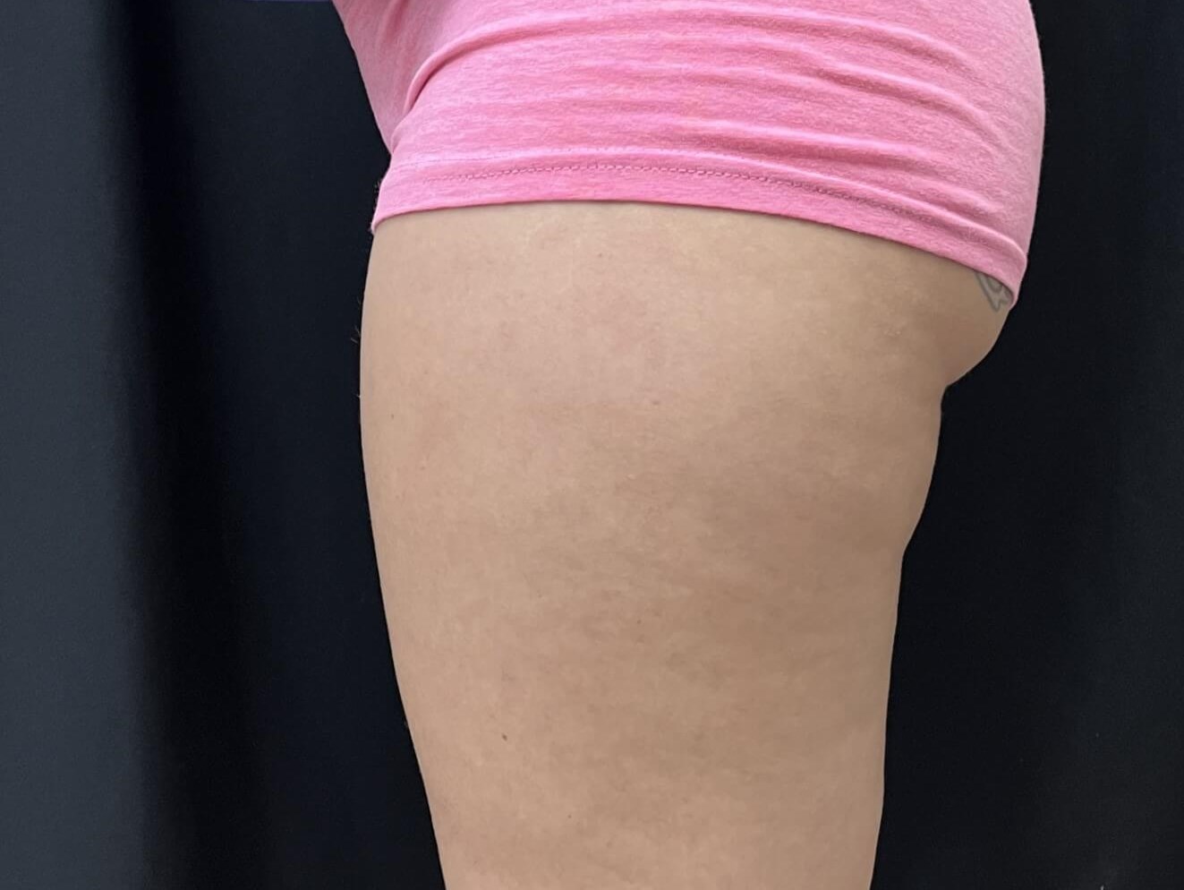 CoolSculpting Banana roll Before