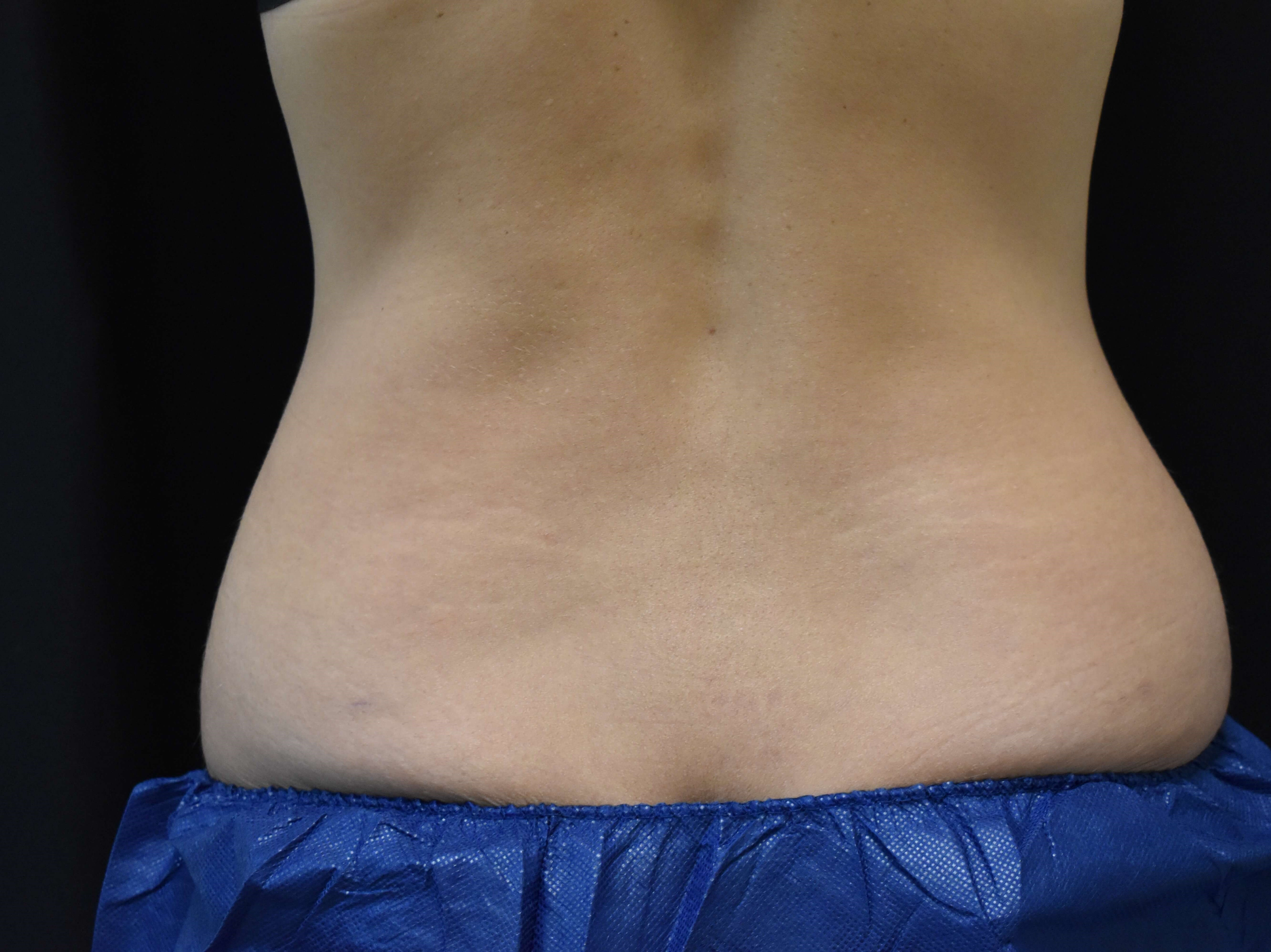 Coolsculpting flanks Before