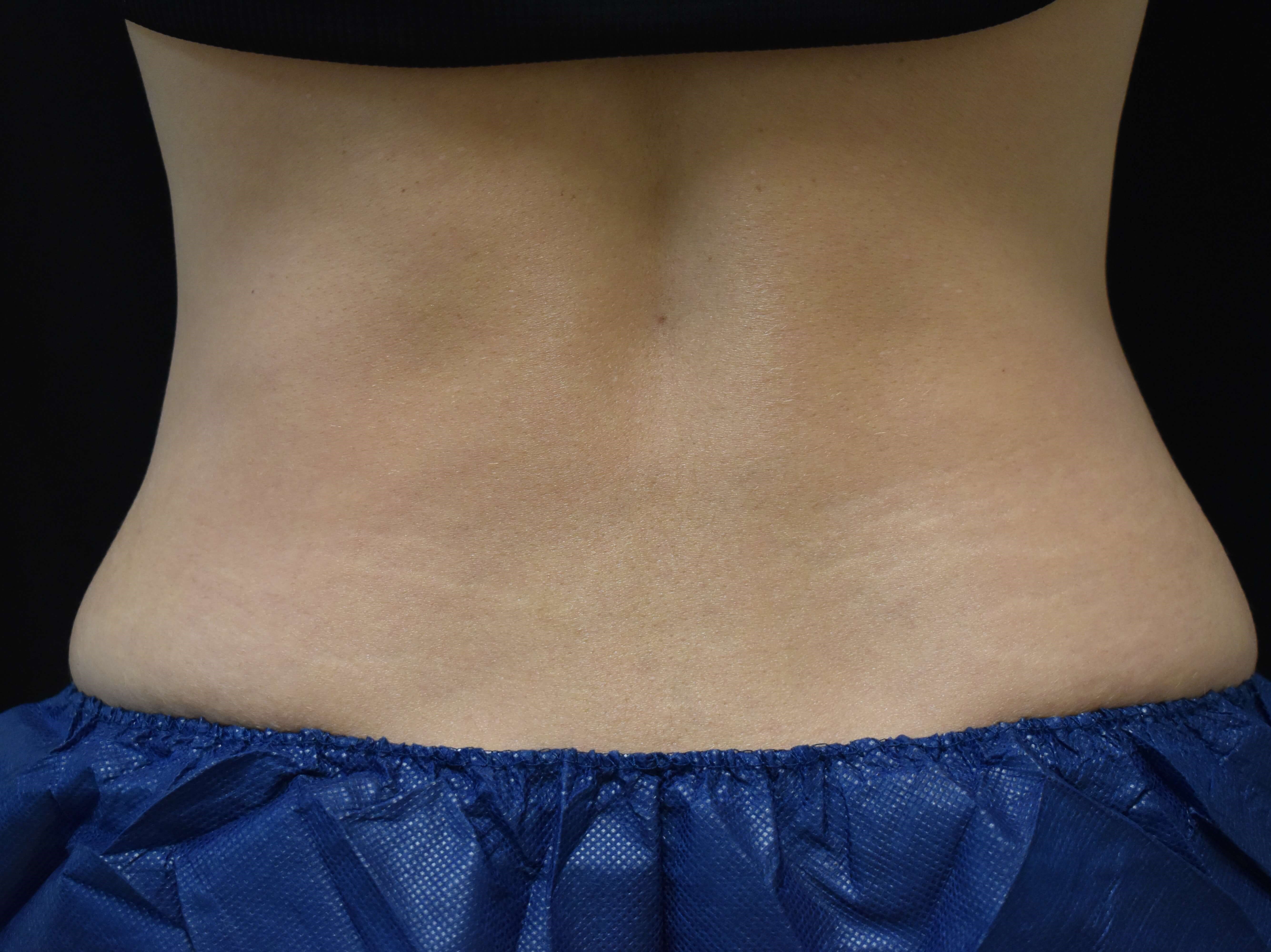 Coolsculpting flanks 3 months after treatment