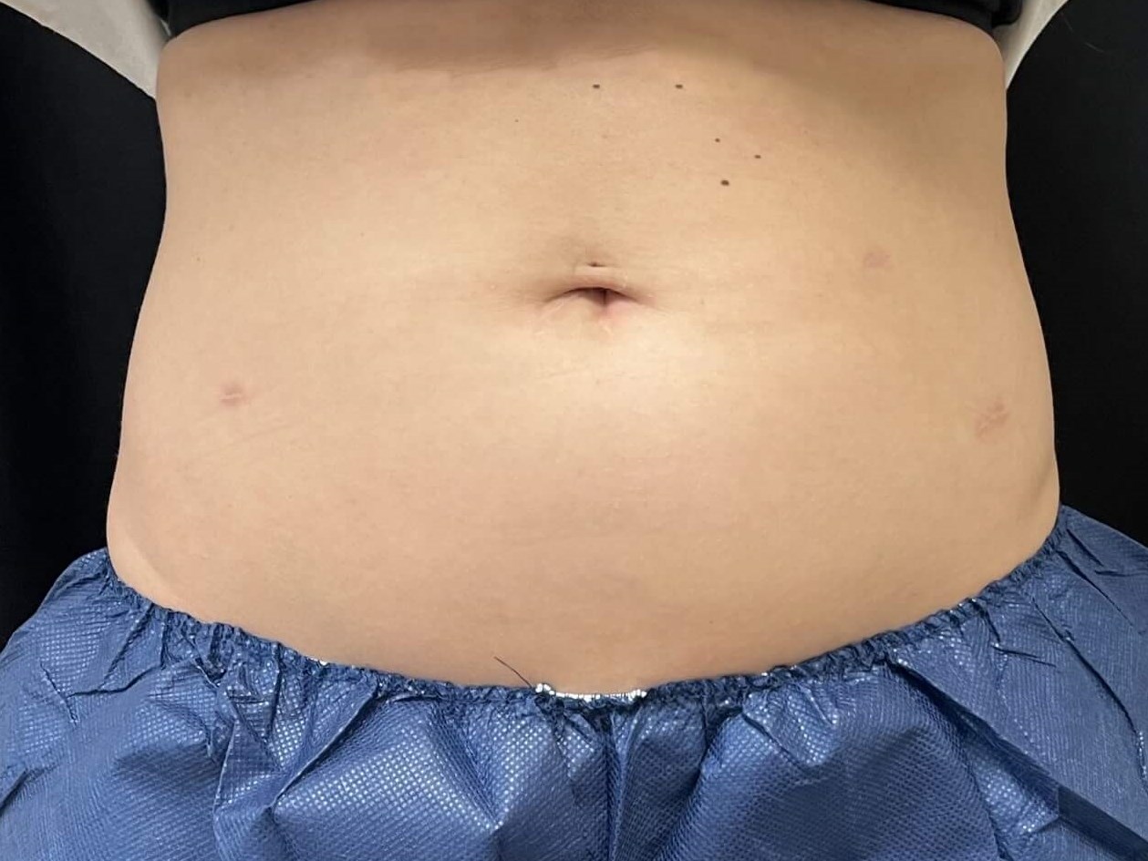Coolsculpting Abdomen Before