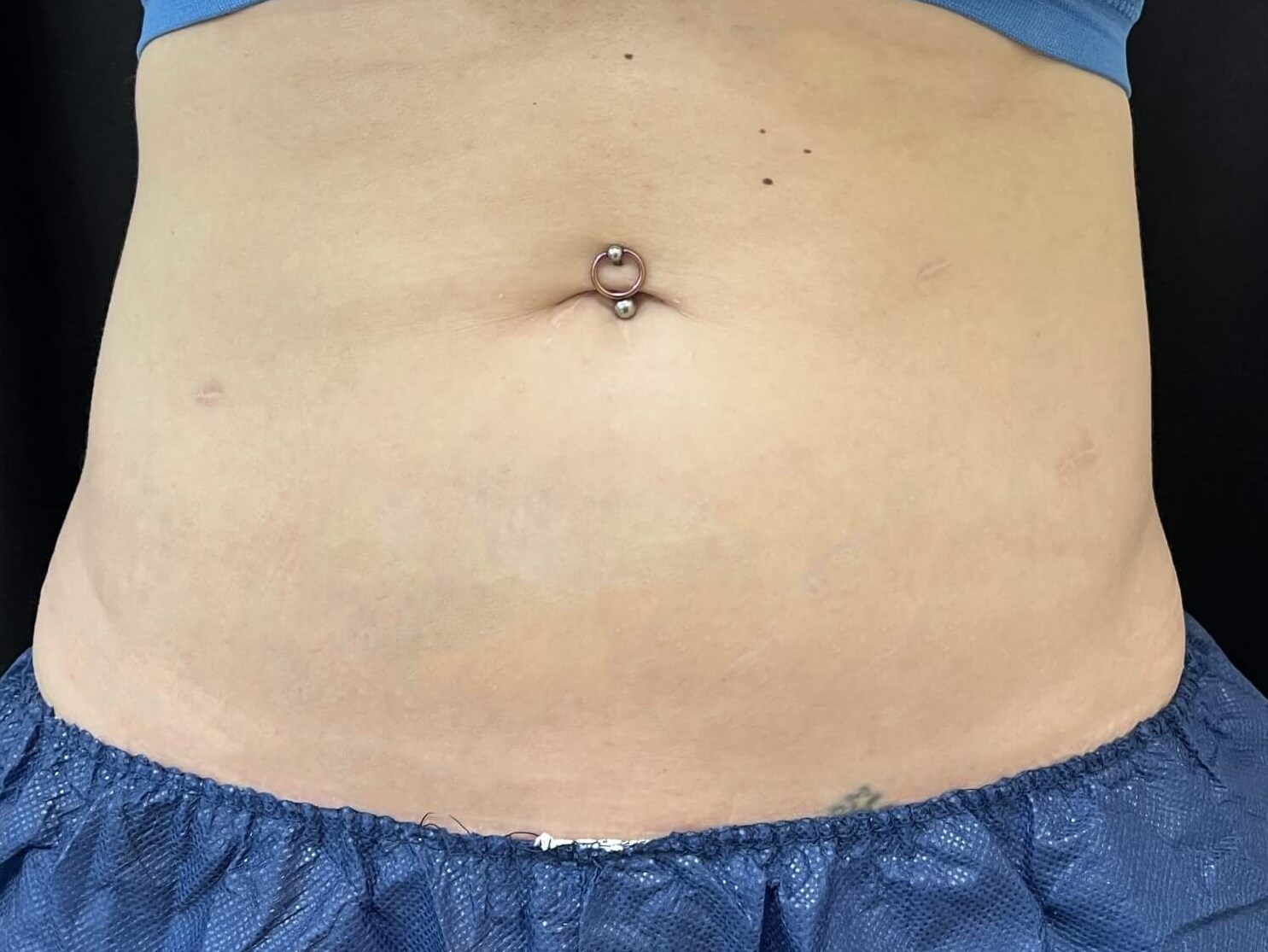 Coolsculpting Abdomen 3 months after treatment