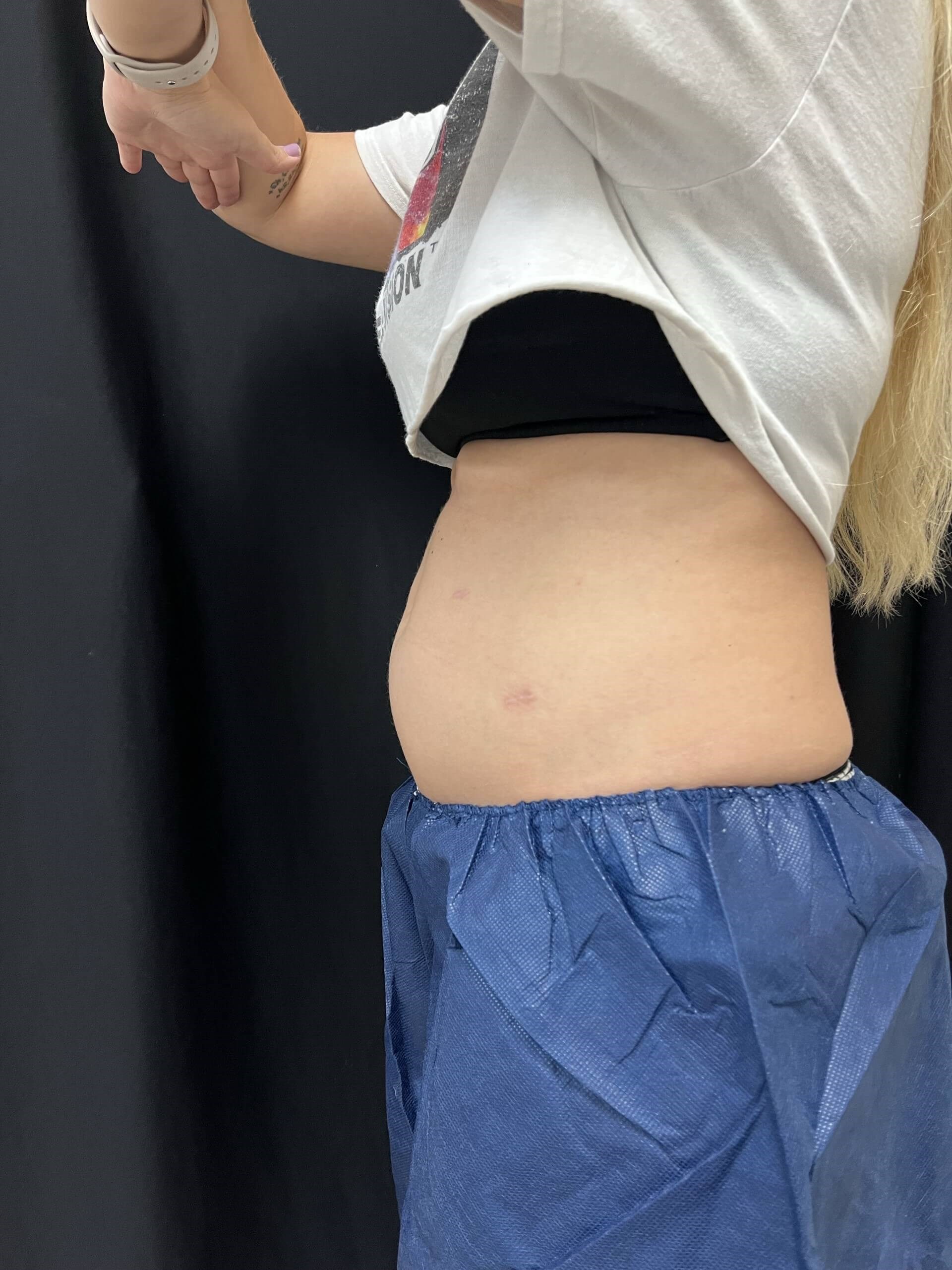 Coolsculpting Abdomen Before - side view