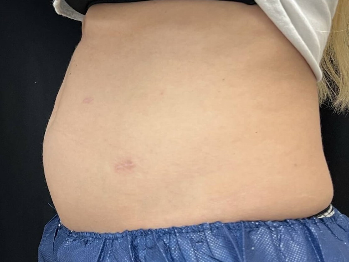 Coolsculpting Abdomen Before - side view