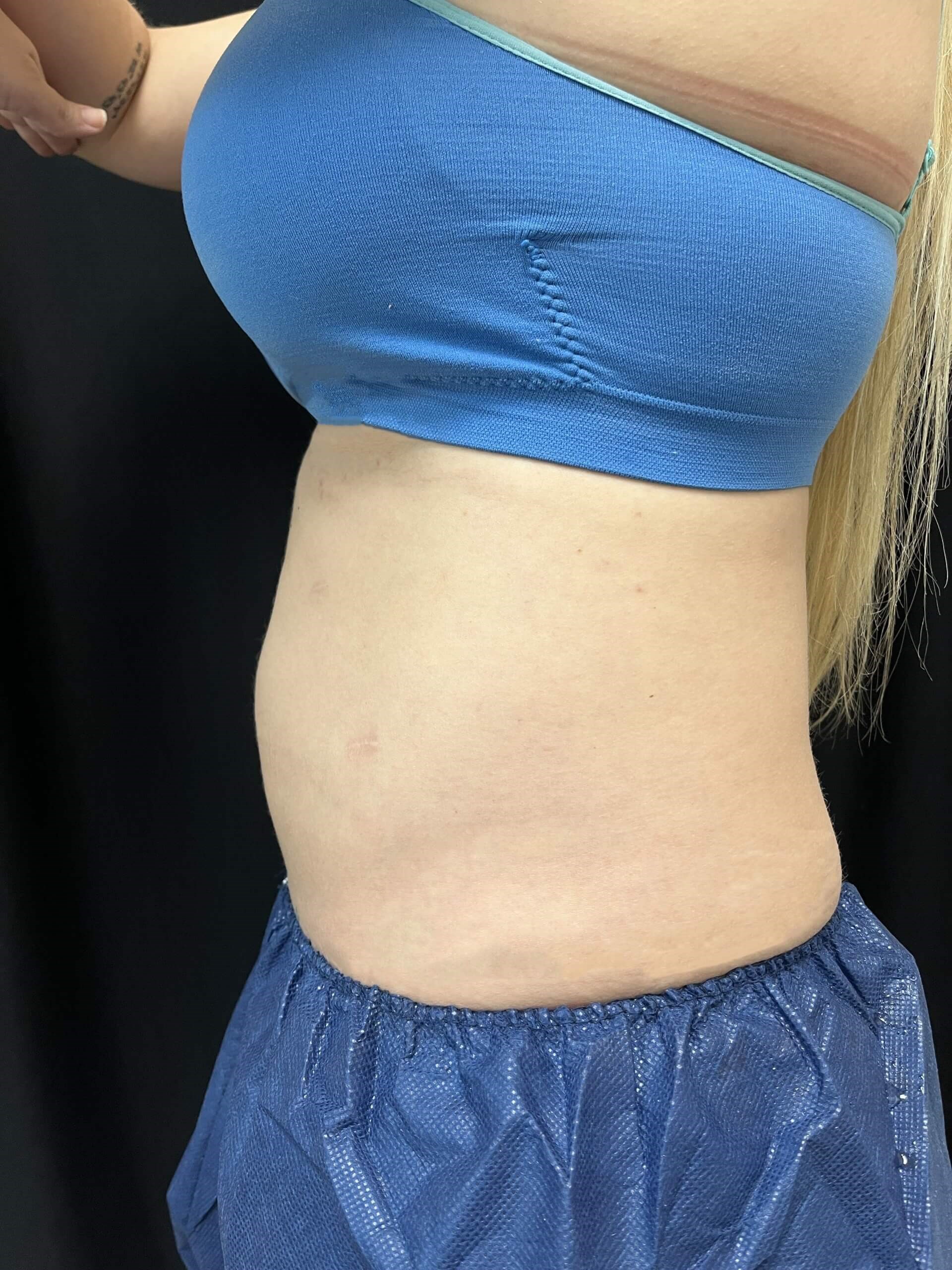 Coolsculpting Abdomen After - side view
