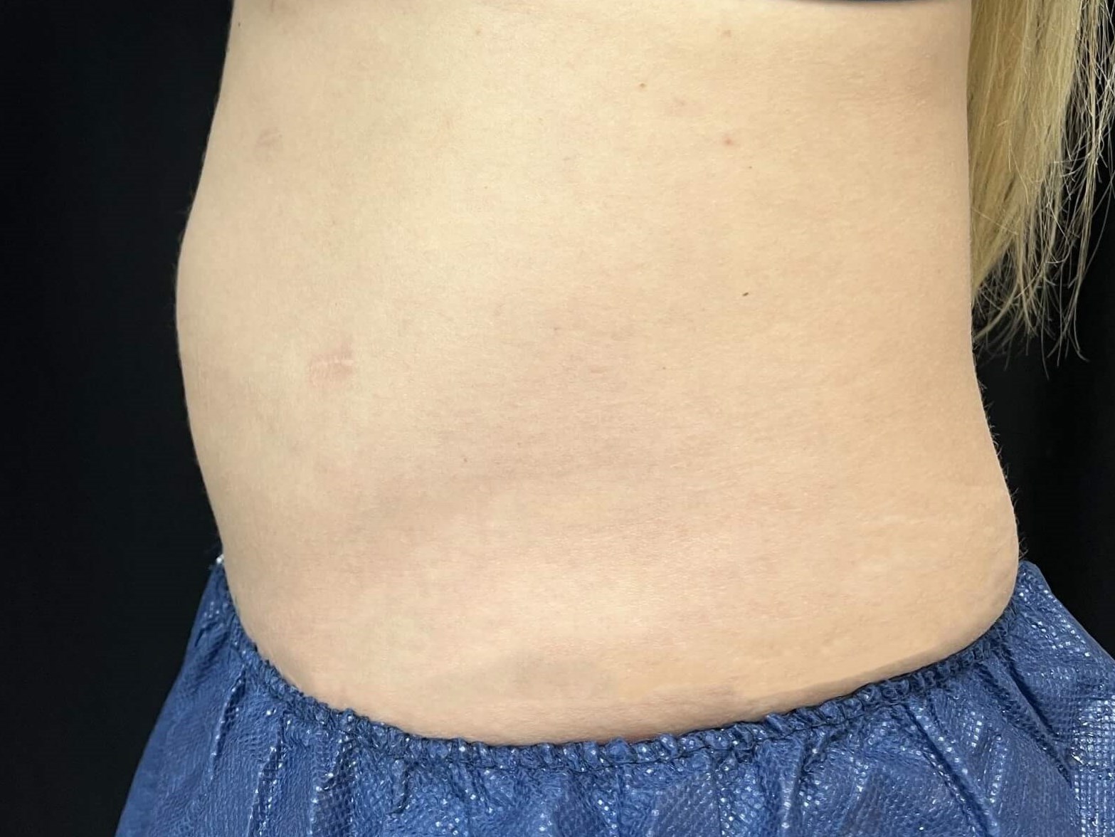 Coolsculpting Abdomen After - side view